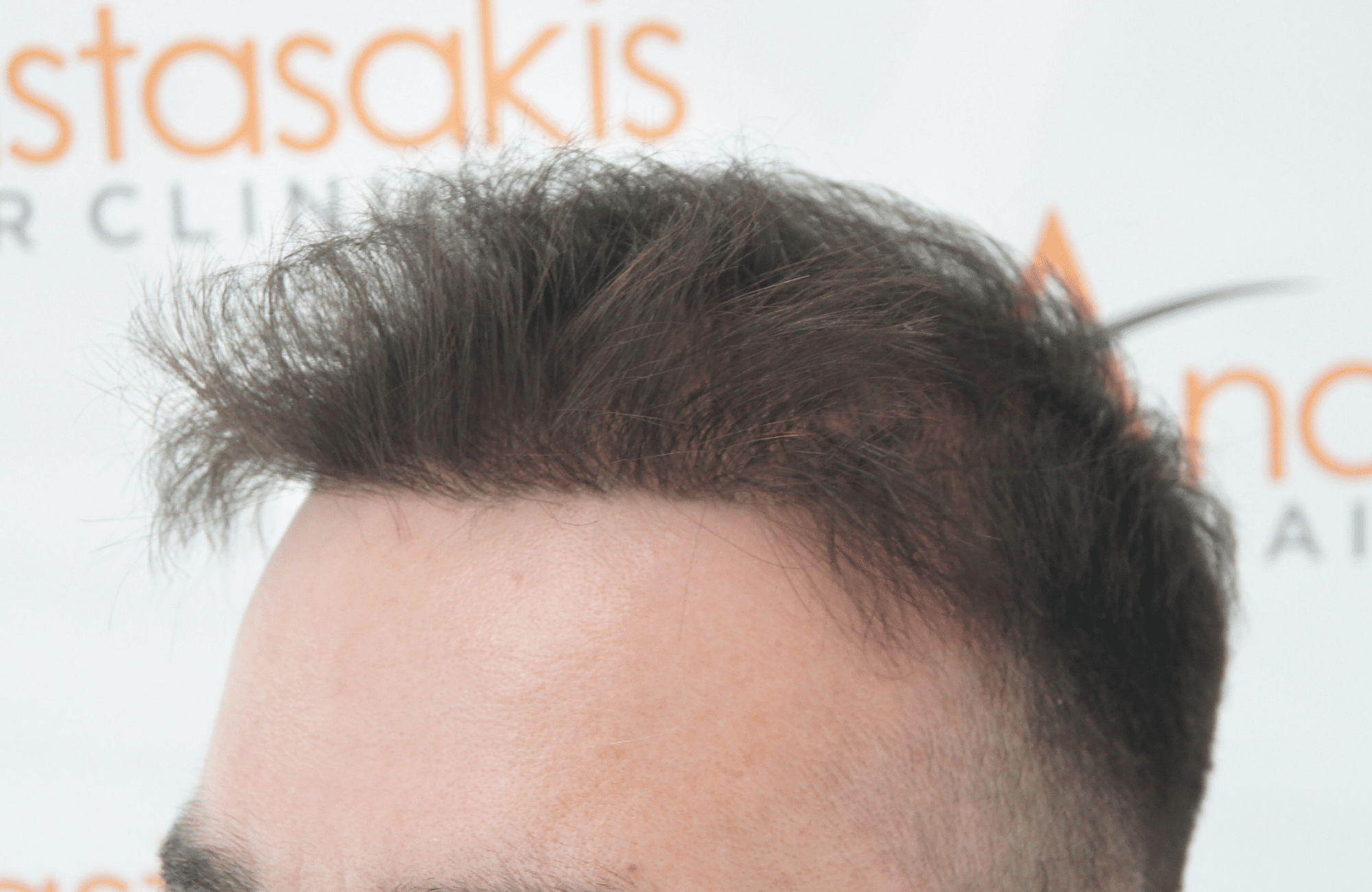 12 months after hair transplant with 2000 fus - side3