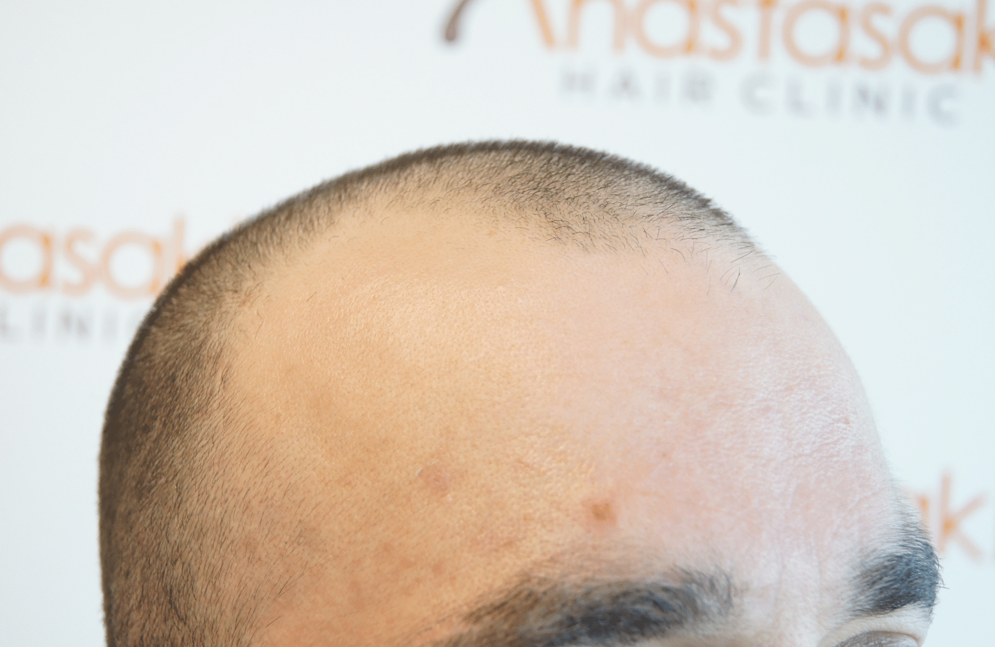 before hair transplant with 2000 fus - side4