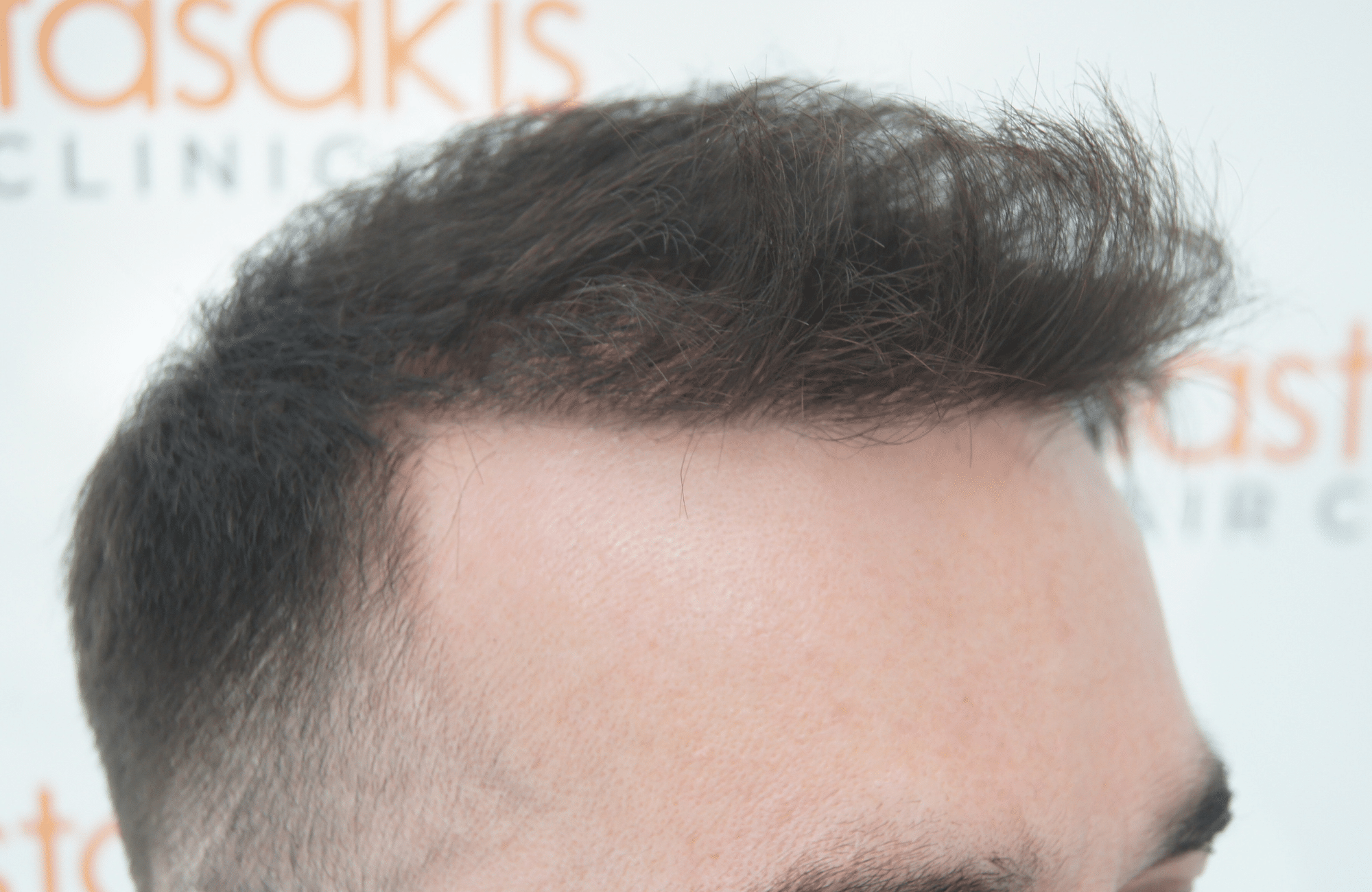 12 months after hair transplant with 2000 fus - side4