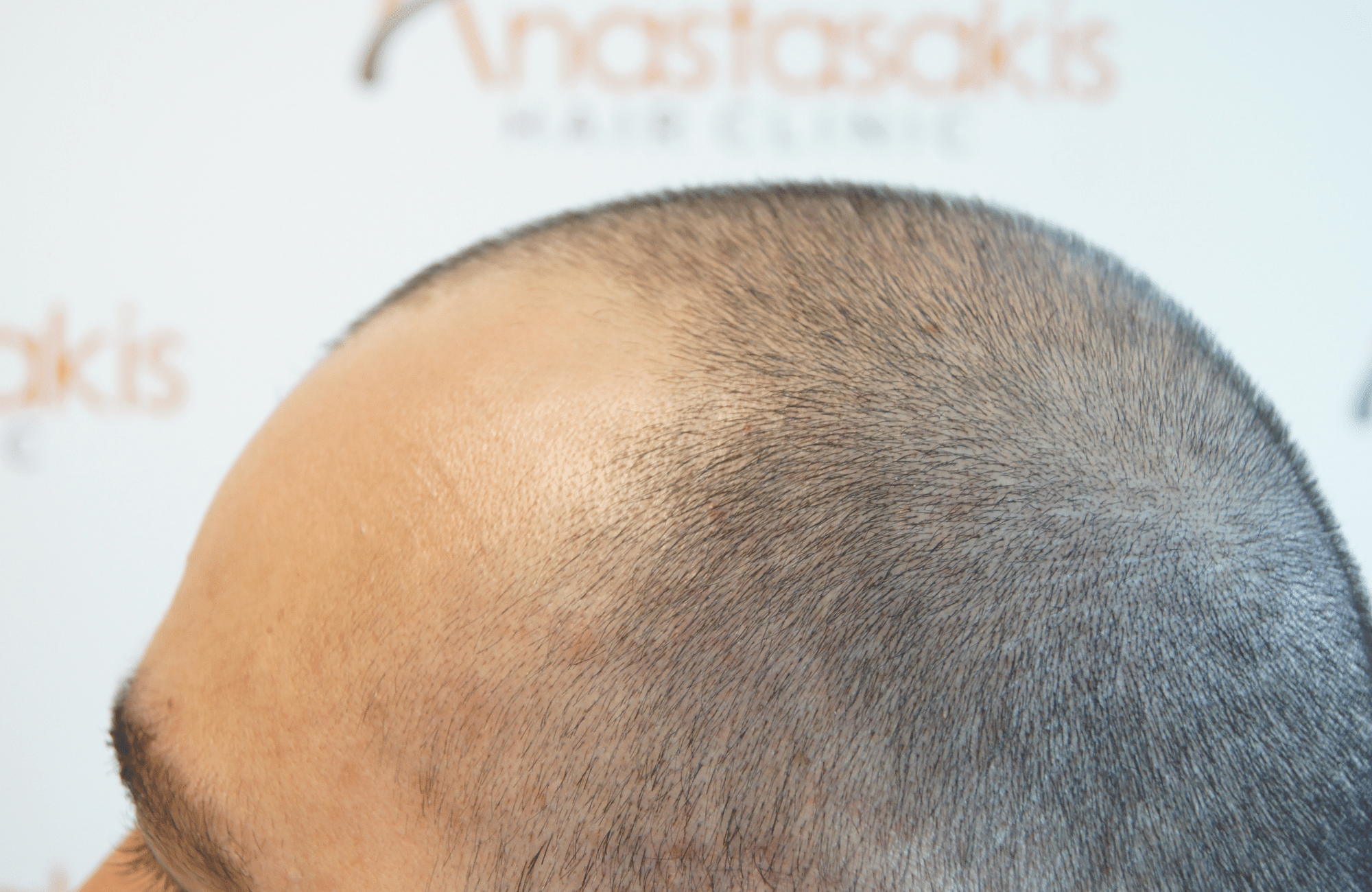 before hair transplant with 2000 fus - side1