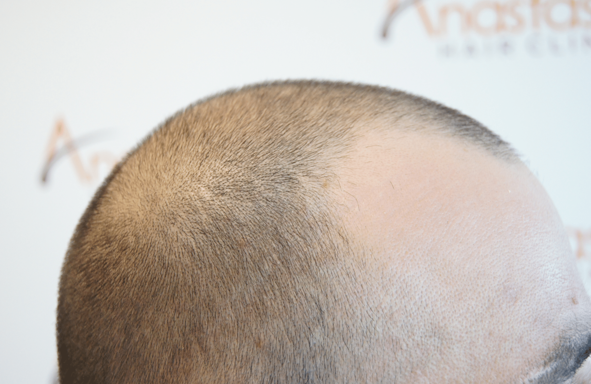 before hair transplant with 2000 fus - side2