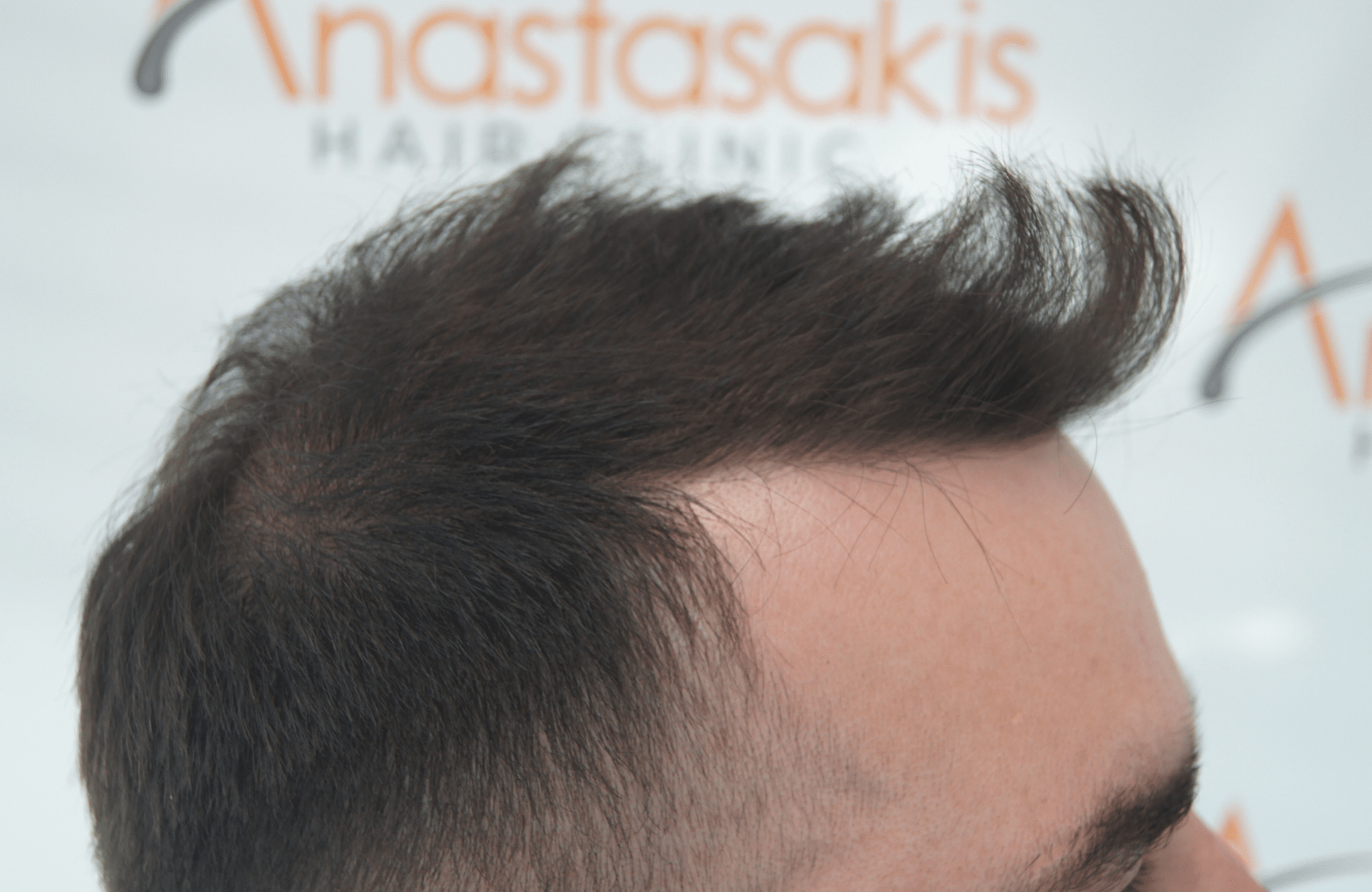 12 months after hair transplant with 2000 fus - side2