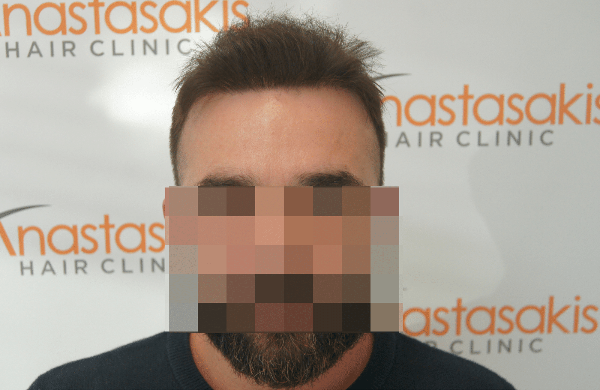 12 months after hair transplant with 2000 fus - fullface
