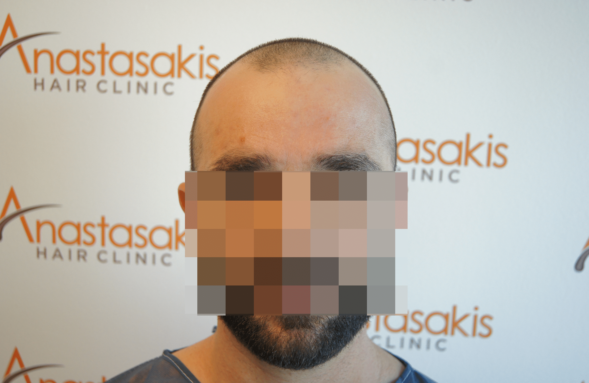 before hair transplant with 2000 fus - fullface