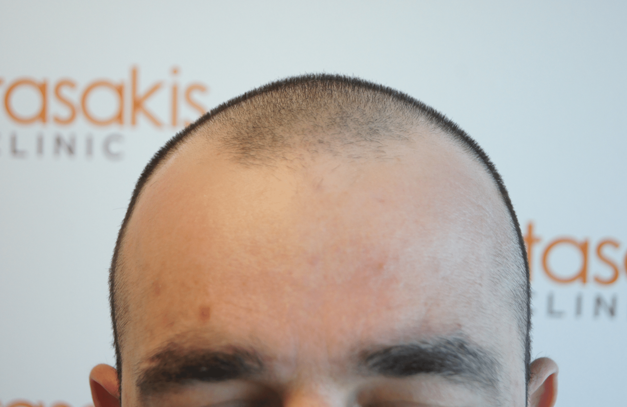 before hair transplant with 2000 fus - hairline