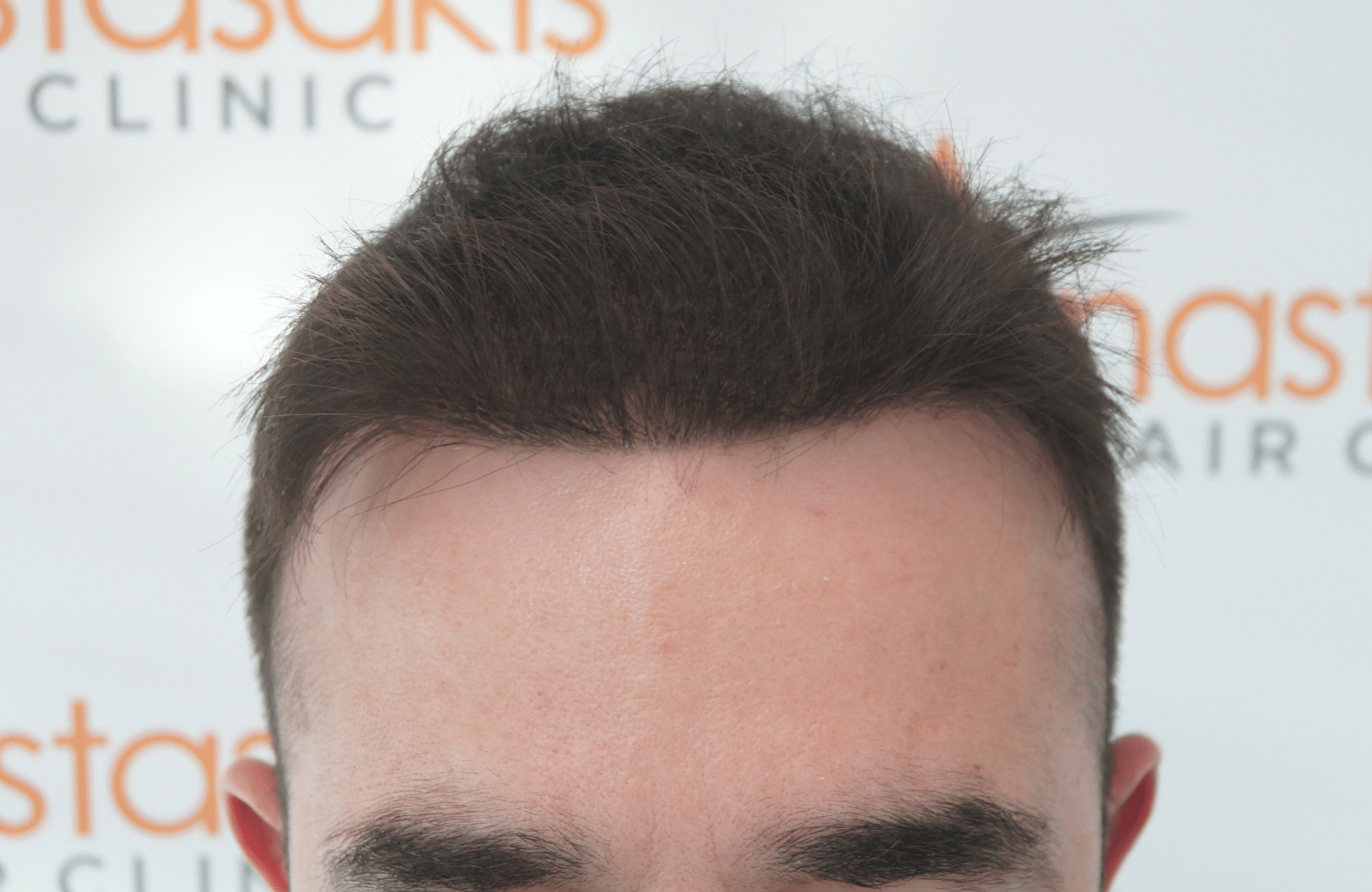 12 months after hair transplant with 2000 fus - hairline