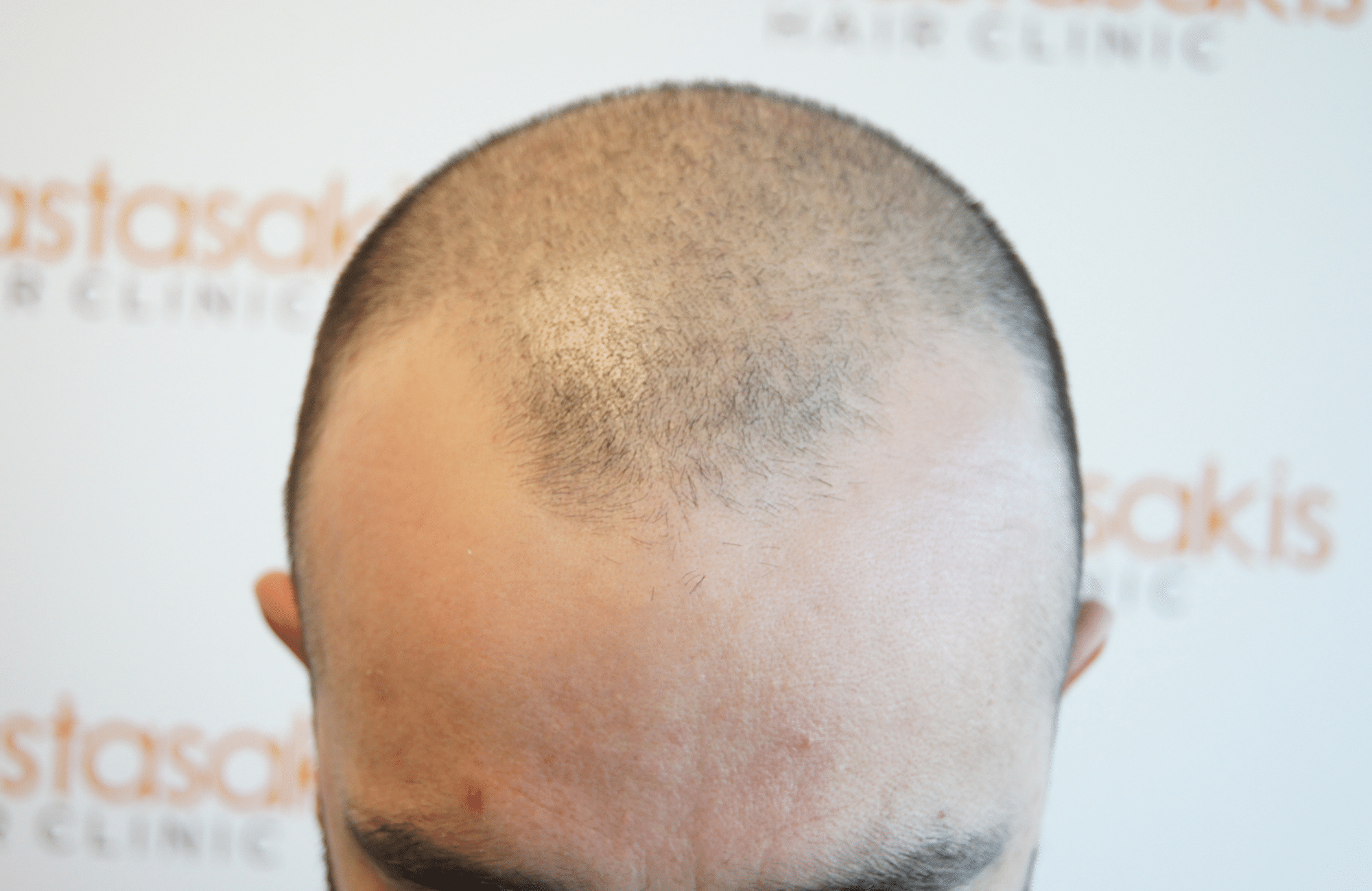 before hair transplant with 2000 fus - frontal