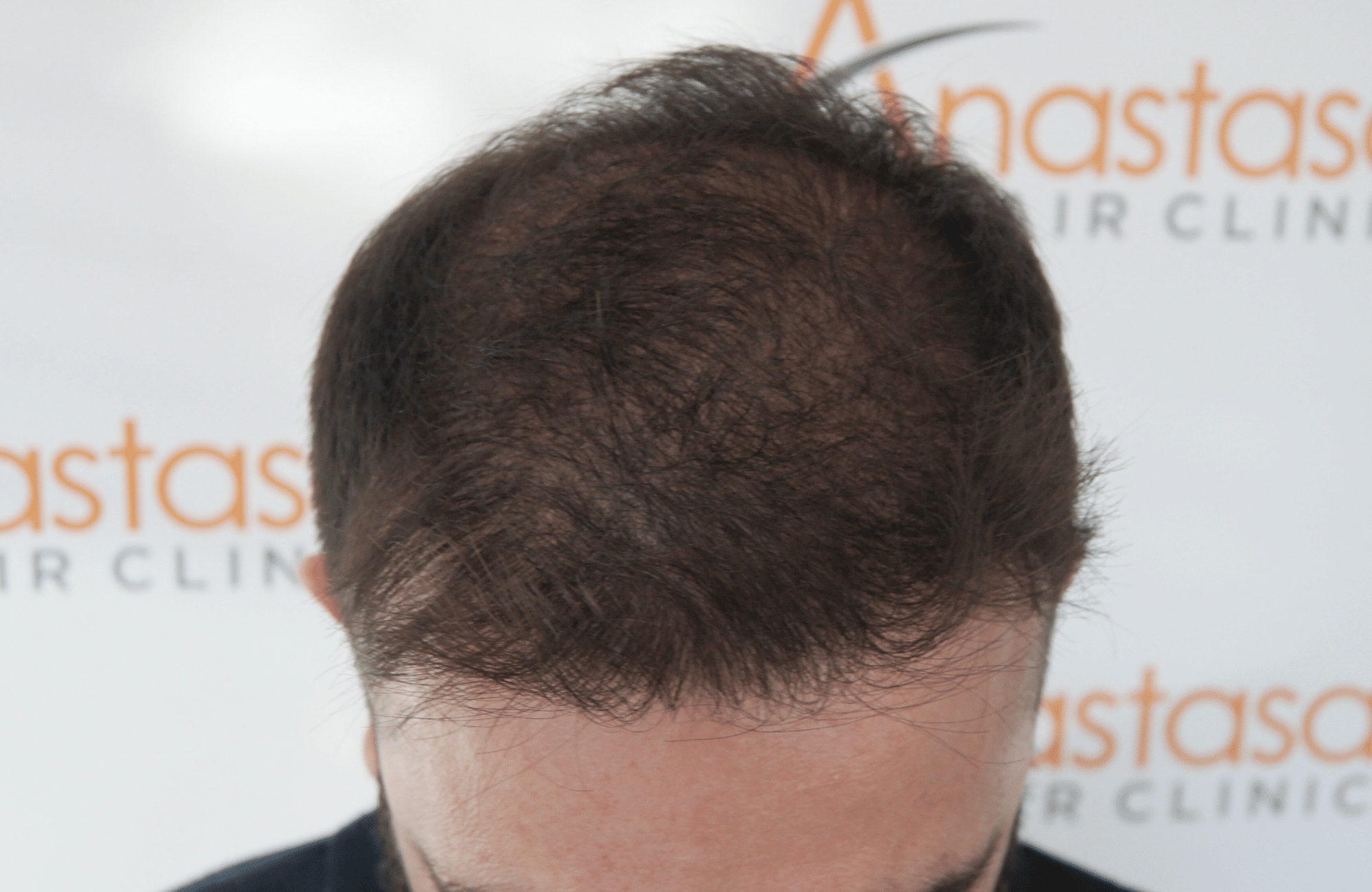 12 months after hair transplant with 2000 fus - frontal