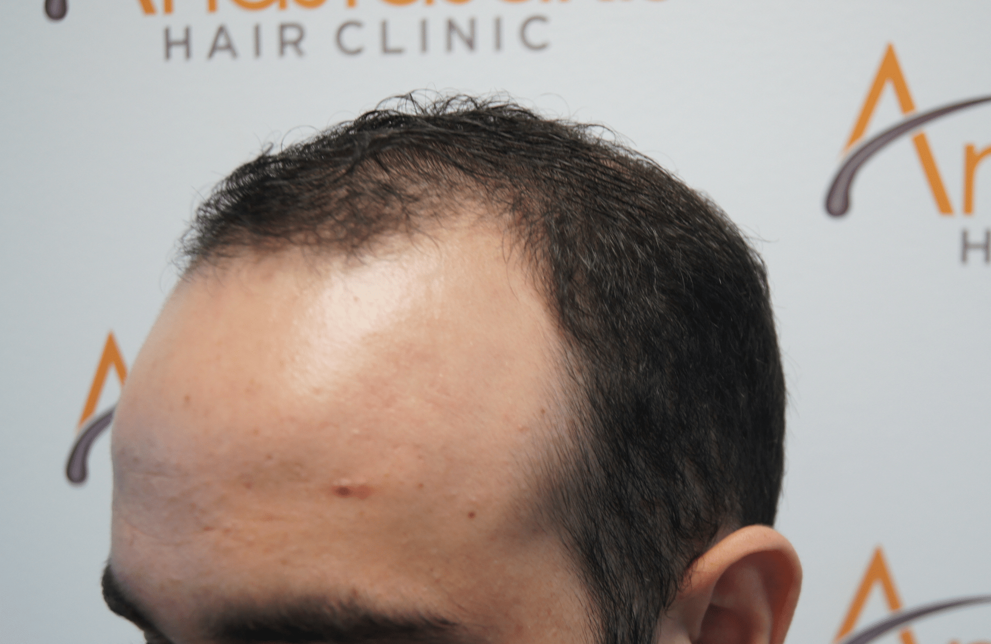 hair transplant patient result with 1500 fus before - side1