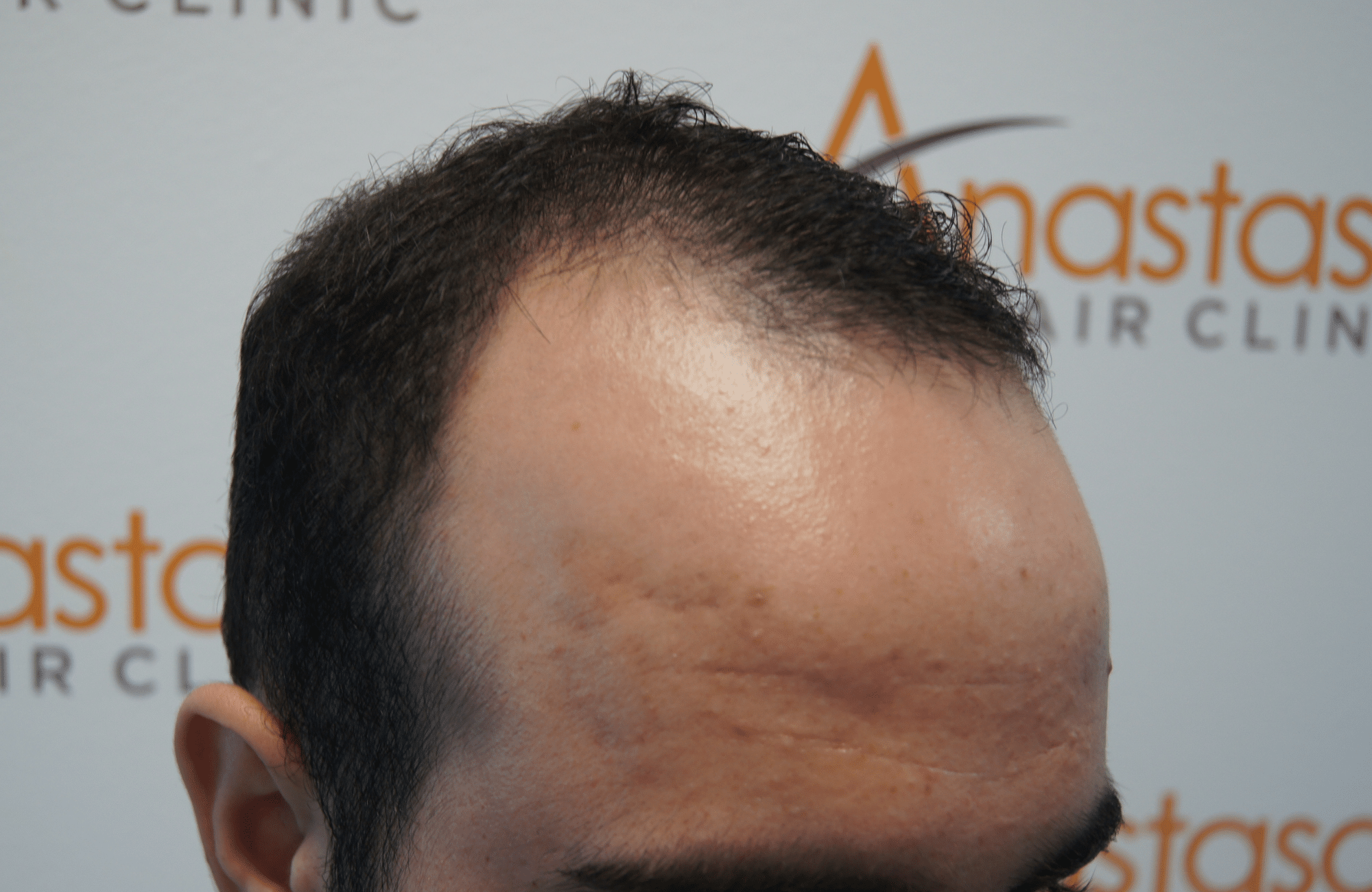 hair transplant patient result with 1500 fus before - side2