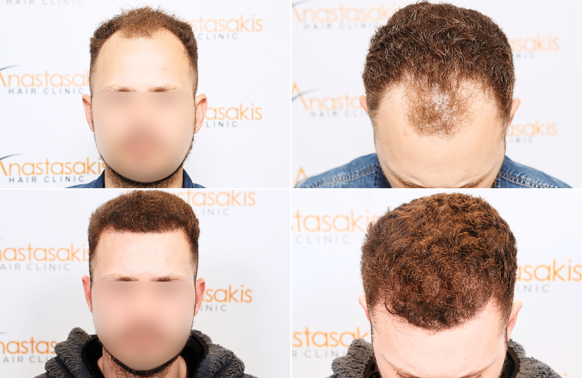 https://anastasakishairclinic.com/portfolio/hair-transplant-result-anastasakis-hair-clinic-387/