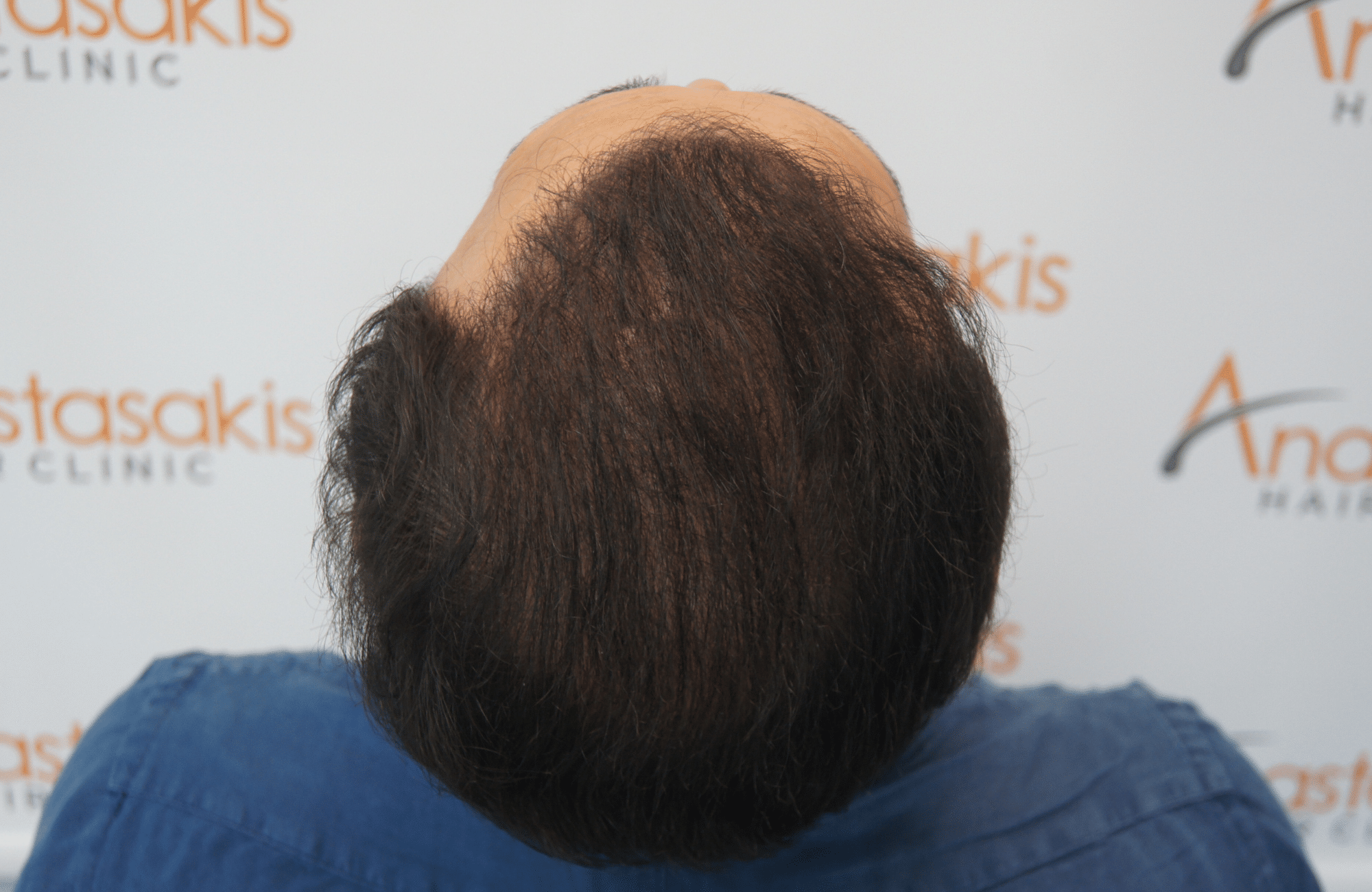 hair transplant patient result with 3200 fus after - crown