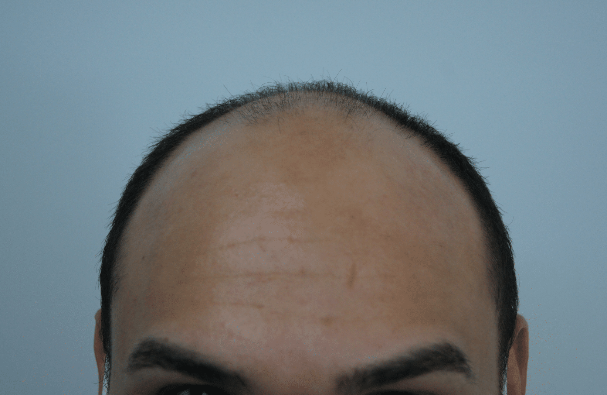 hair transplant patient result with 3200 fus before - hairline