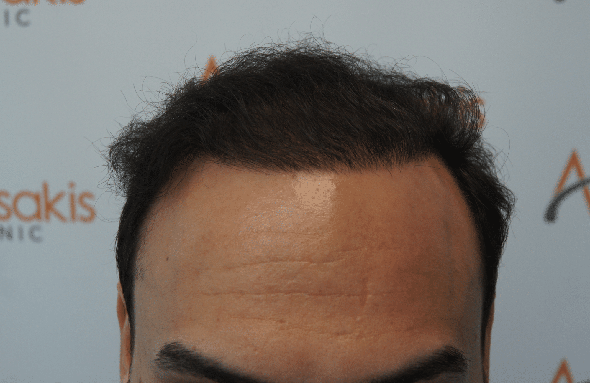 hair transplant patient result with 3200 fus after - hairline