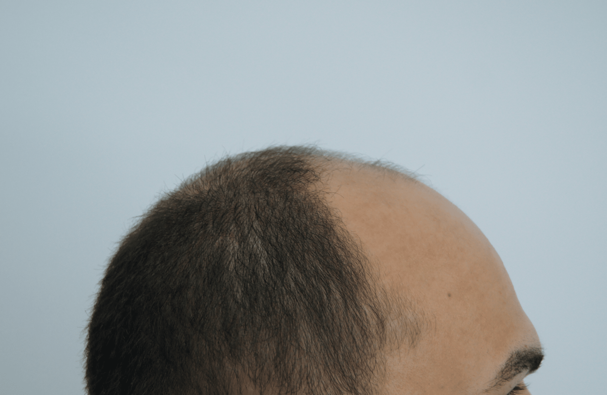 hair transplant patient result with 3200 fus before - side2