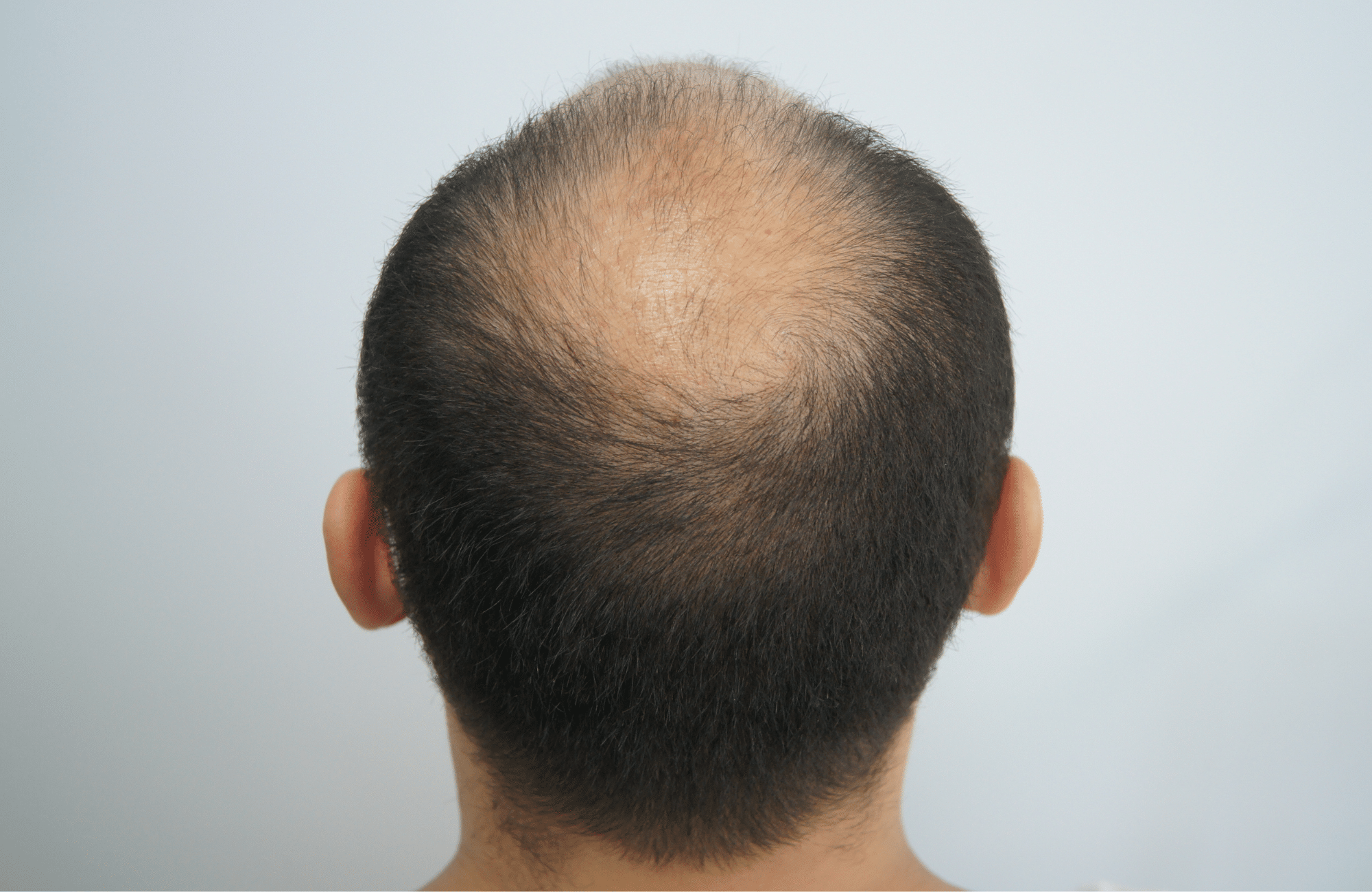 hair transplant patient result with 3200 fus before - crown
