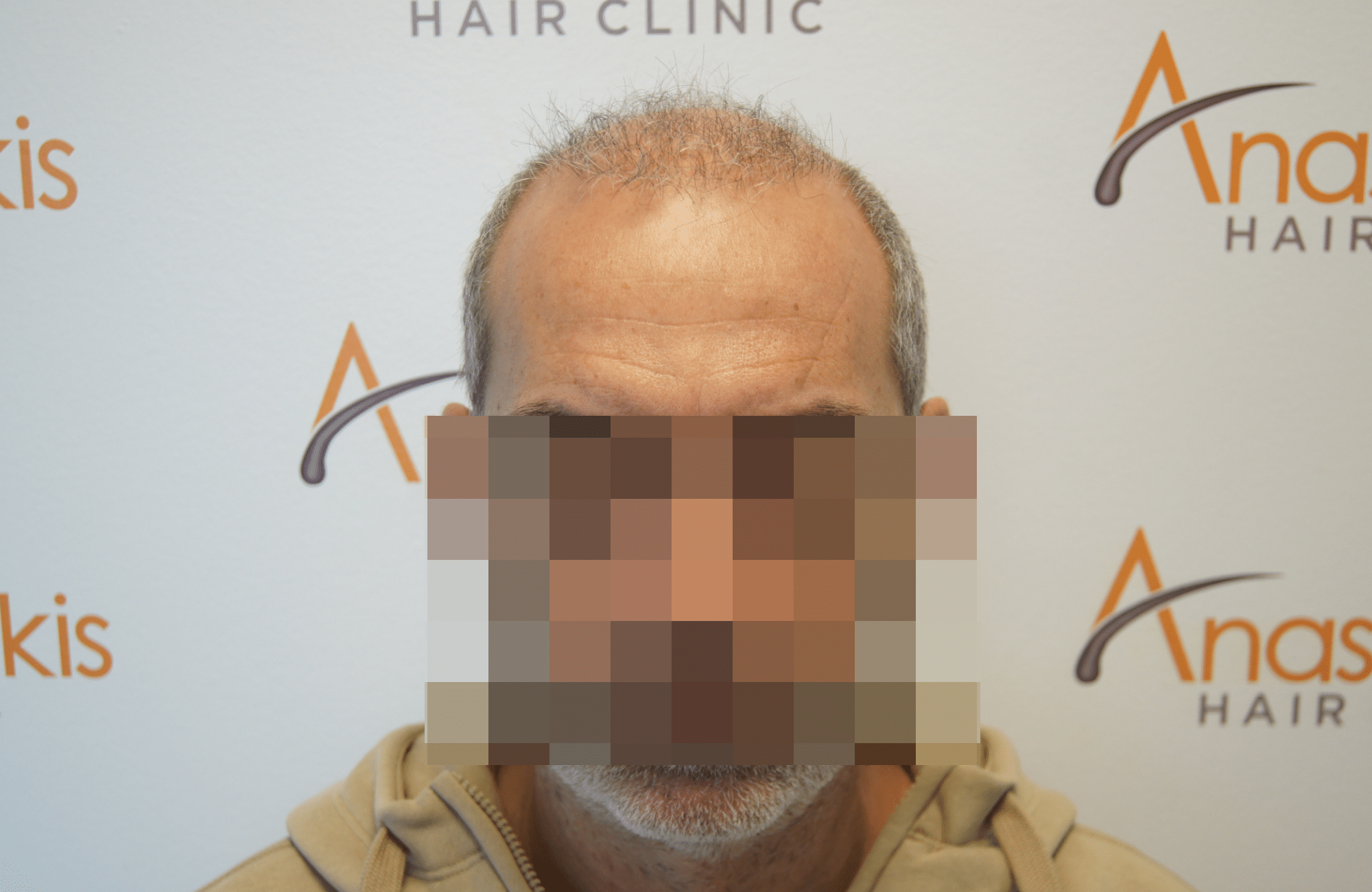 hair transplant result - repair session with 2500 fus before - fullface
