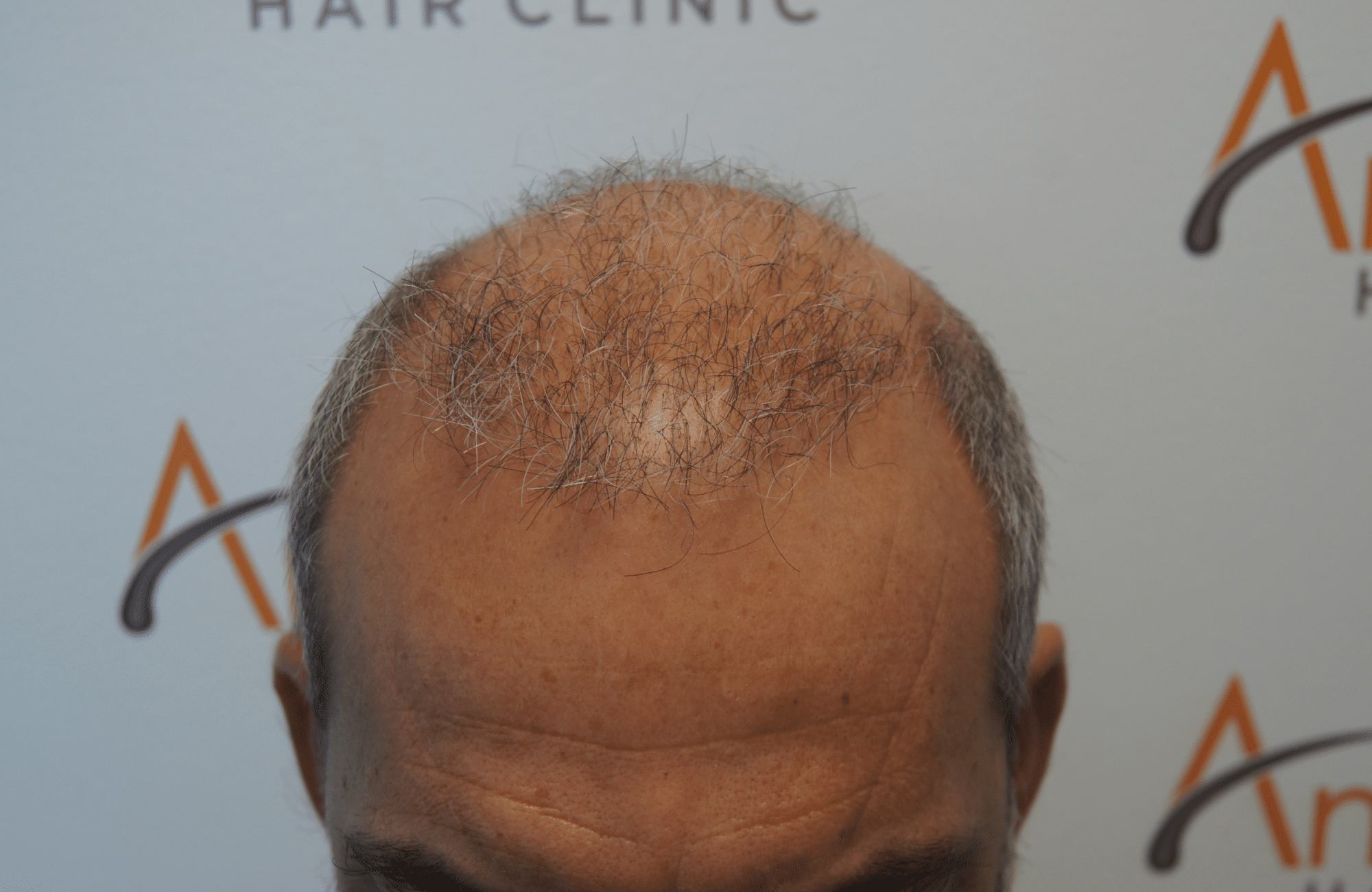 hair transplant result - repair session with 2500 fus before - frontal