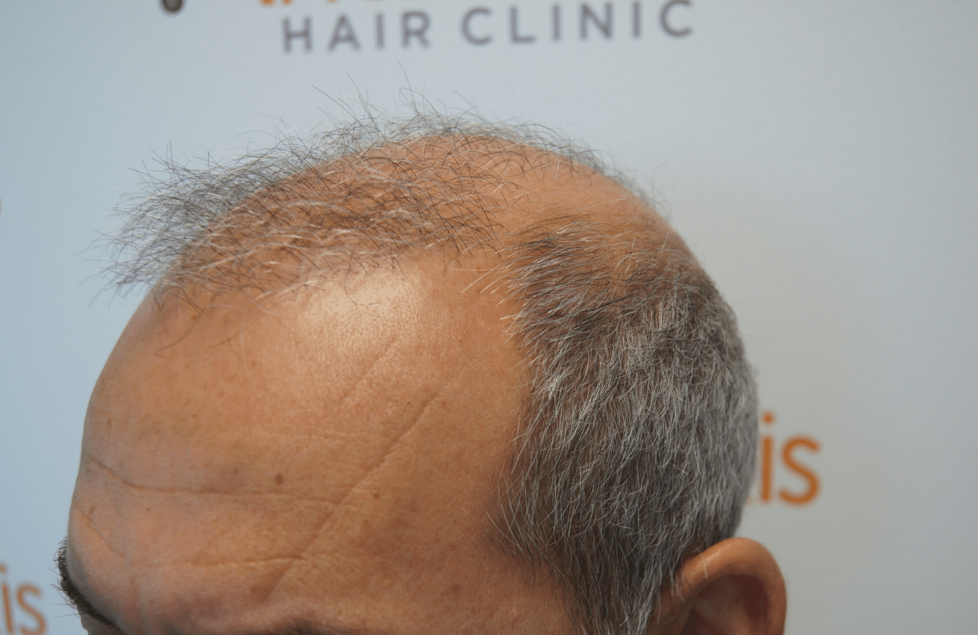 hair transplant result - repair session with 2500 fus before - side1