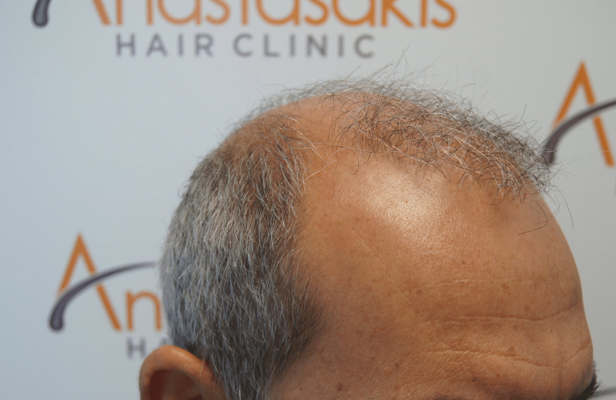 hair transplant result - repair session with 2500 fus before - side2
