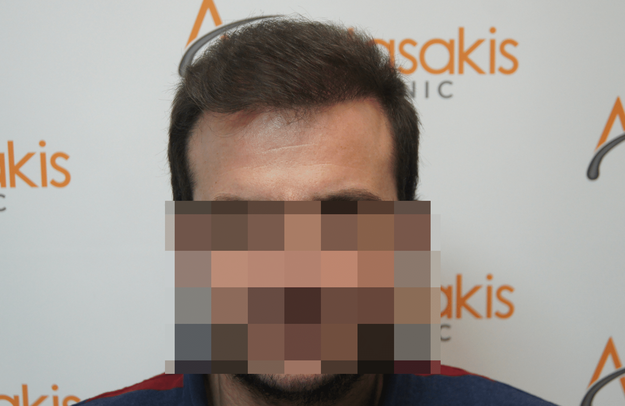 hair transplant result with 2500 grafts after - fullface