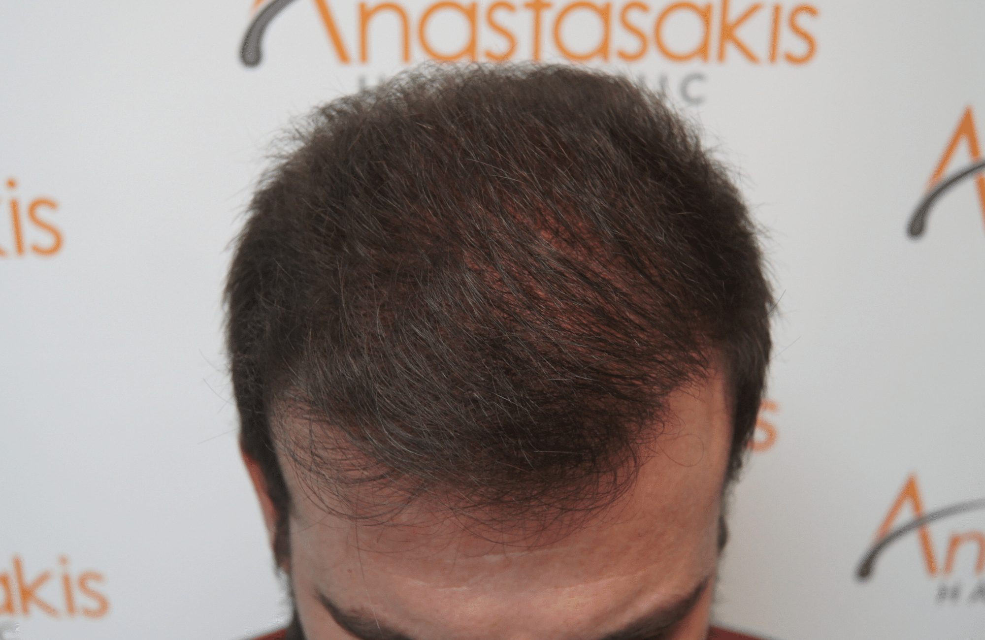 hair transplant result with 2500 grafts after - frontal