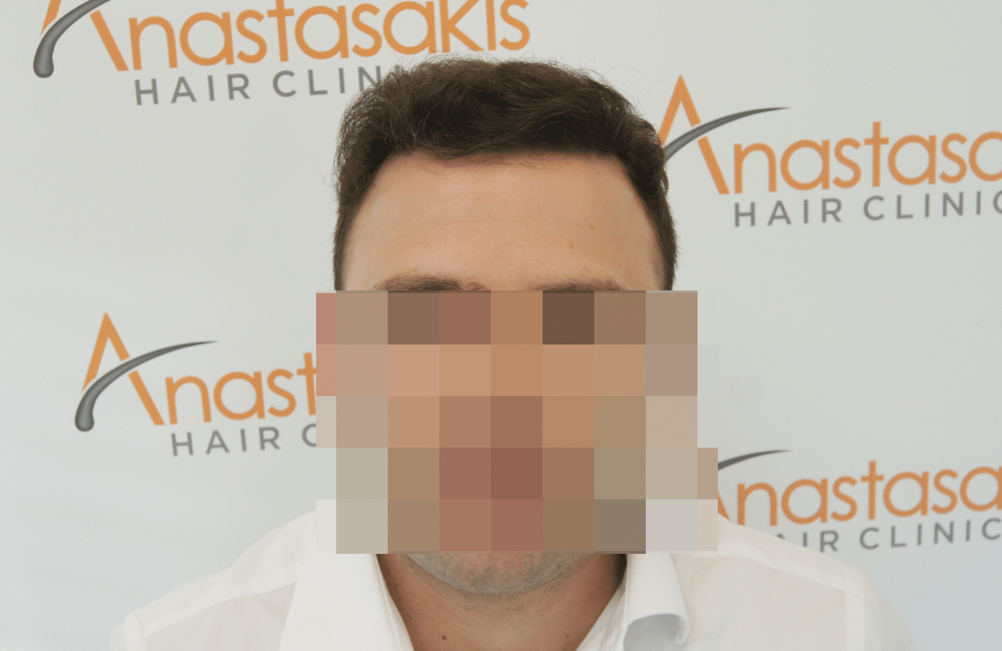 hair transplant result with 2500 fus after - fullface