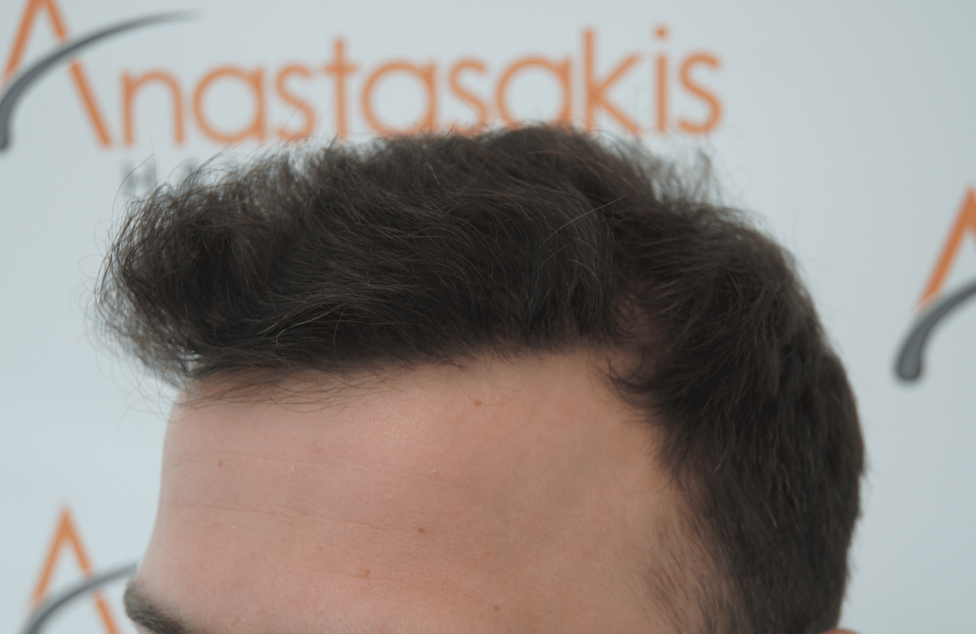 hair transplant result with 2500 fus after - side2