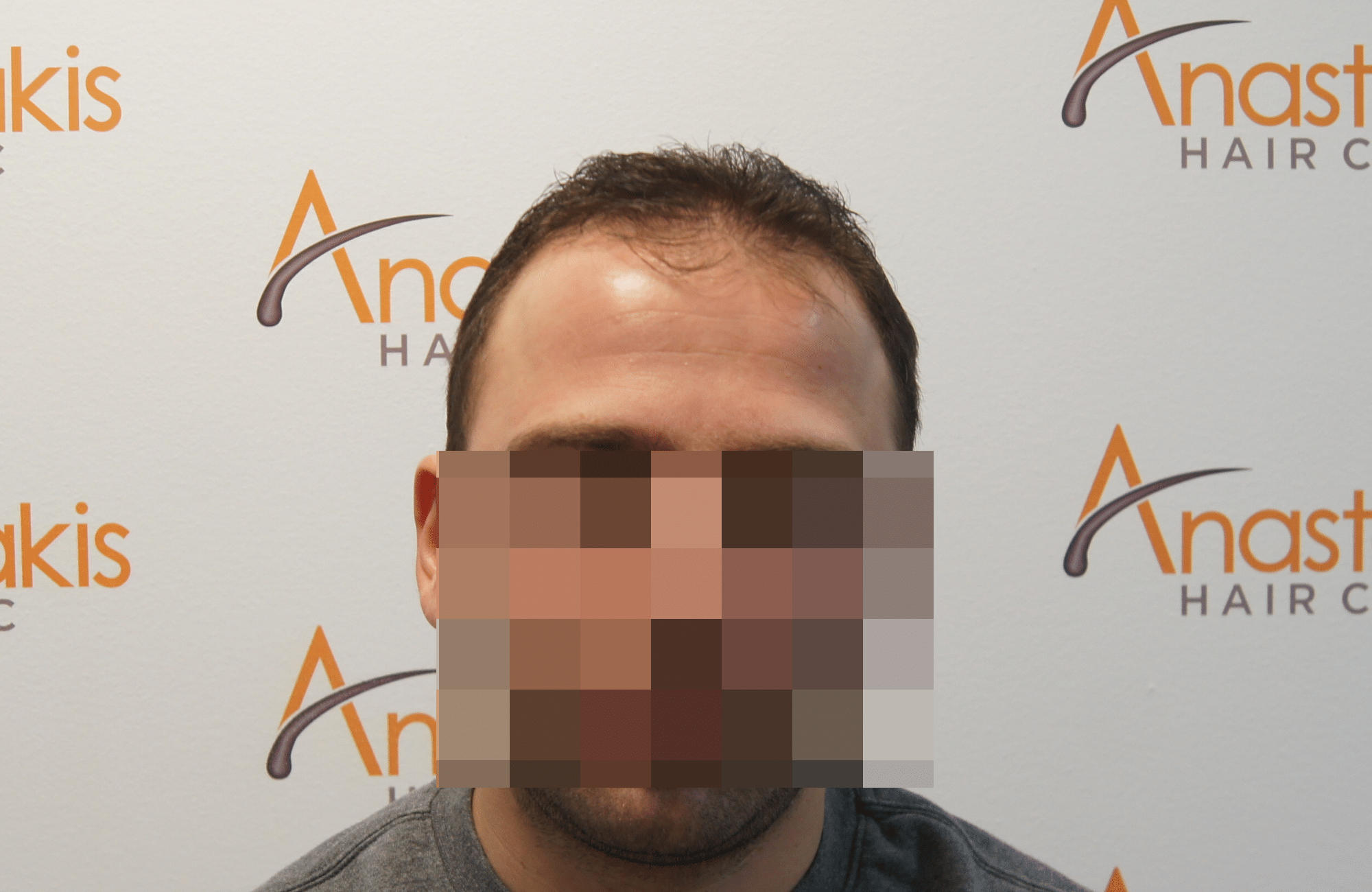 hair transplant result with 2500 fus before - fullface