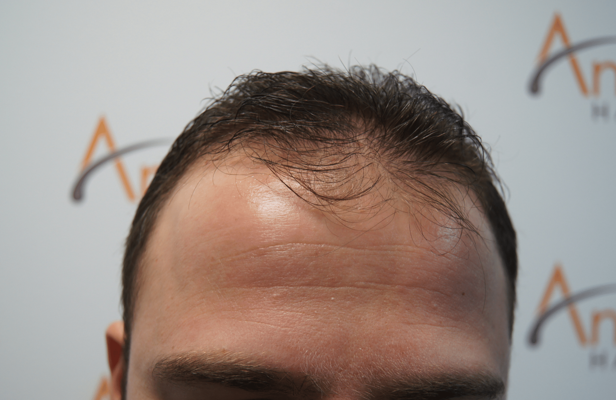 hair transplant result with 2500 fus before - hairline
