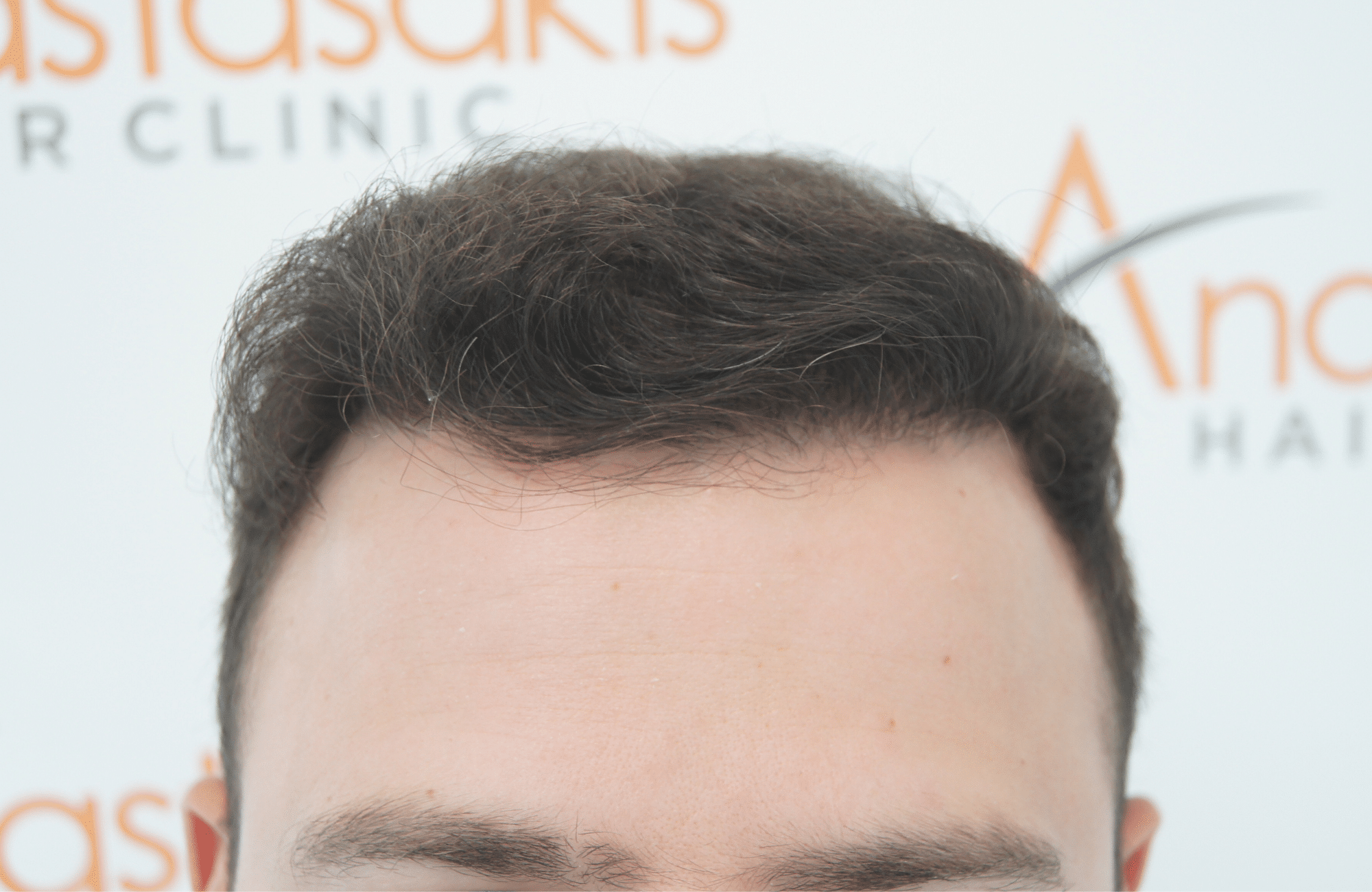 hair transplant result with 2500 fus after - hairline