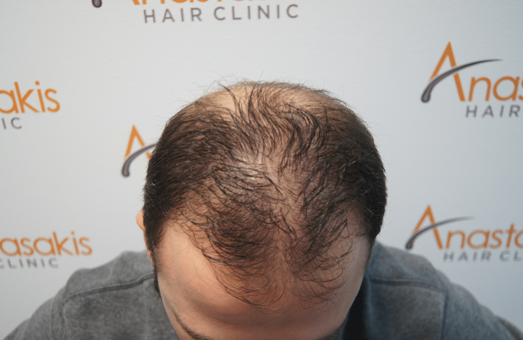hair transplant result with 2500 fus before - frontal