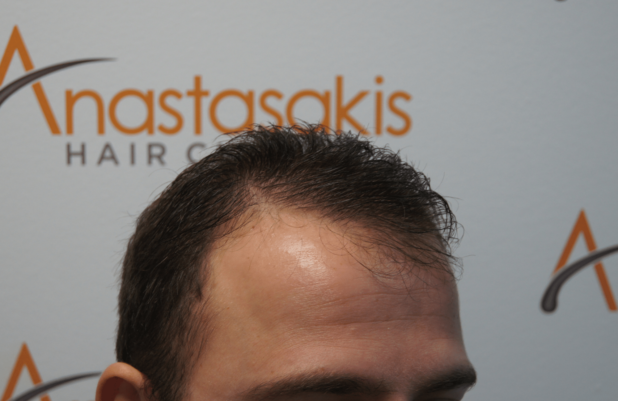 hair transplant result with 2500 fus before - side1