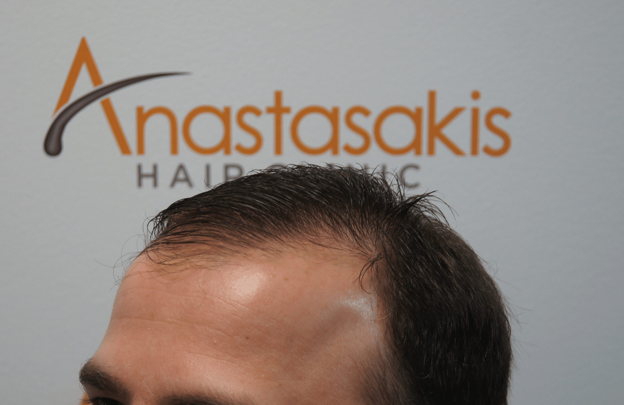hair transplant result with 2500 fus before - side2