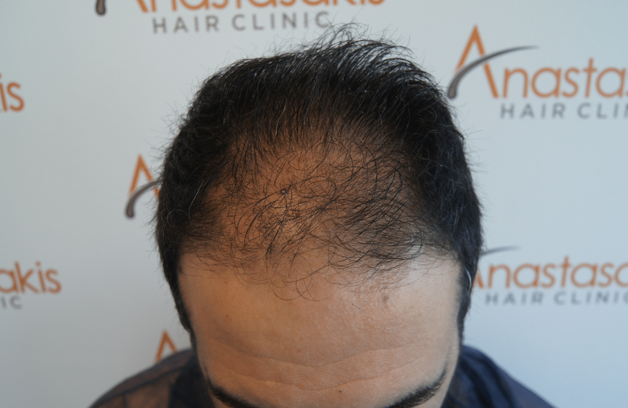 hair transplant patient result with 2700 fus before - frontal