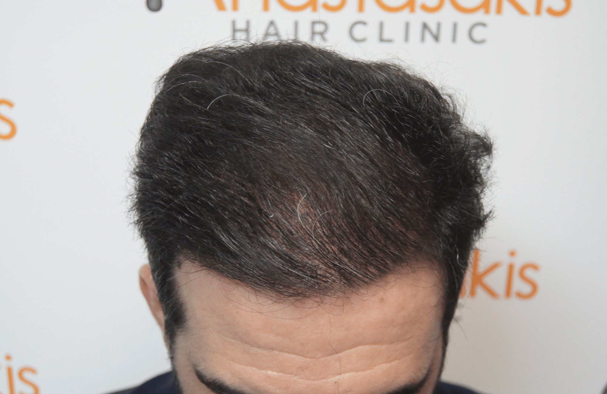 hair transplant patient result with 2700 fus after - frontal