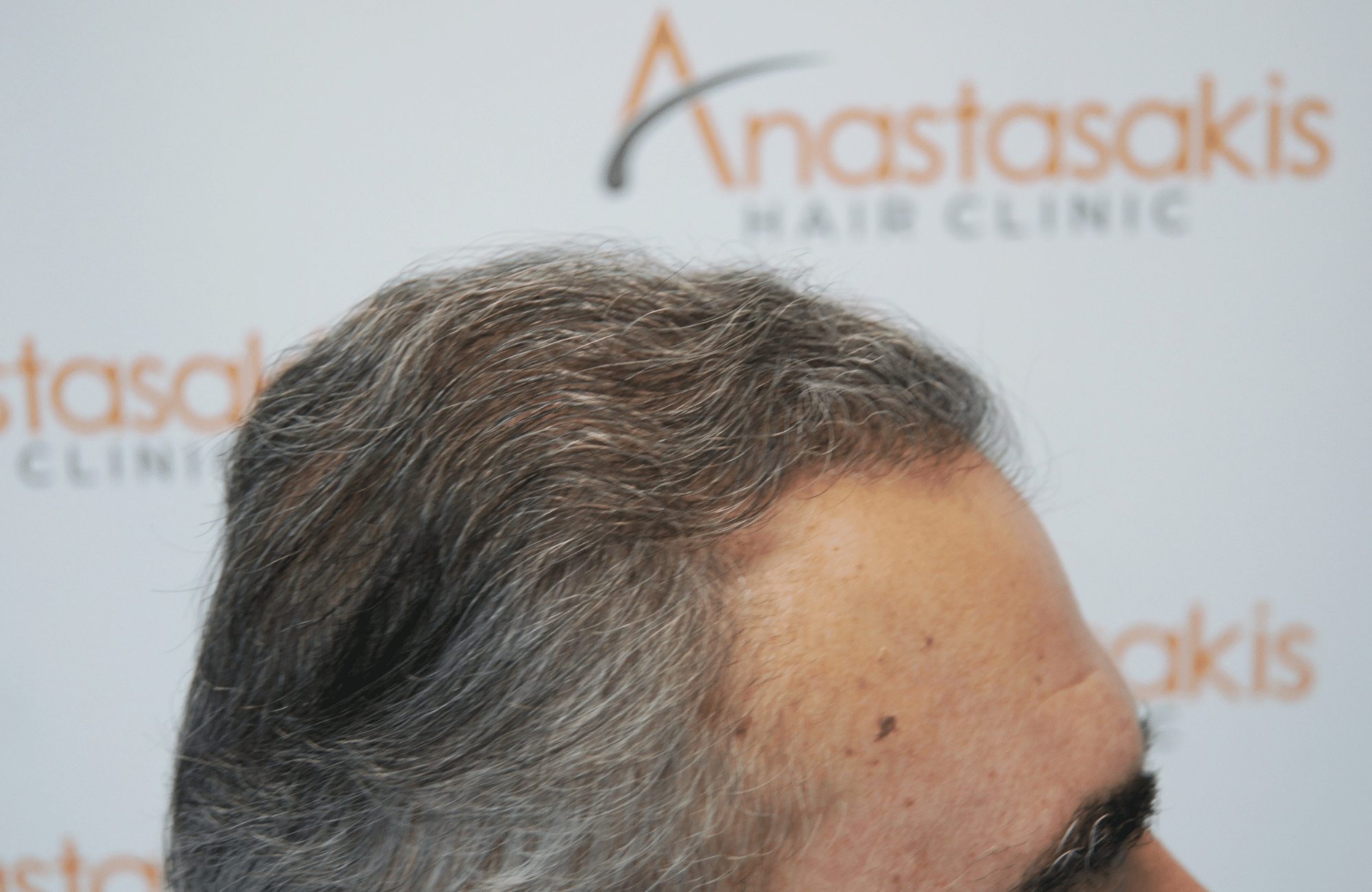 hair transplant patient result with 3000 fus after - side3