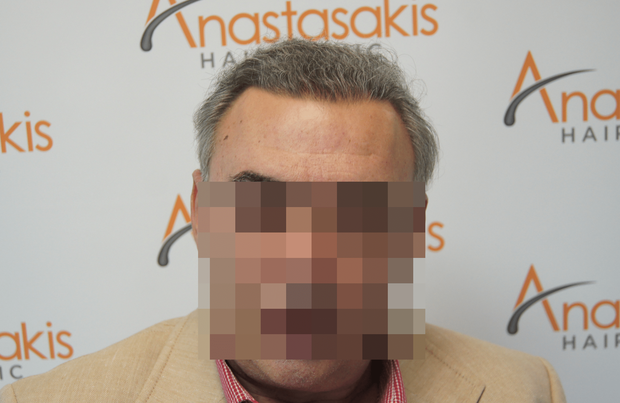 hair transplant patient result with 3000 fus after - fullface