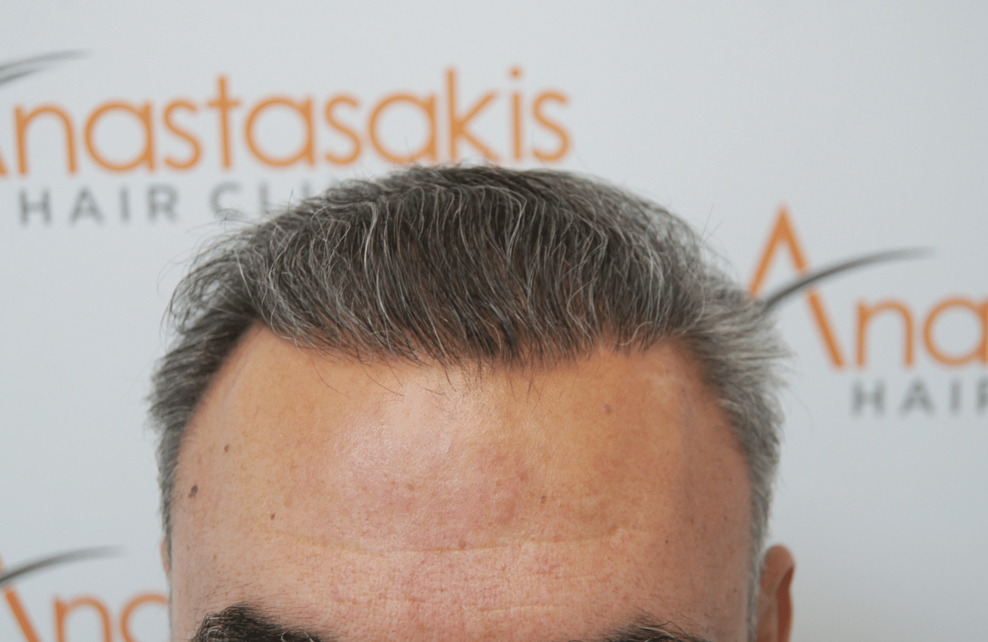 hair transplant patient result with 3000 fus after - hairline