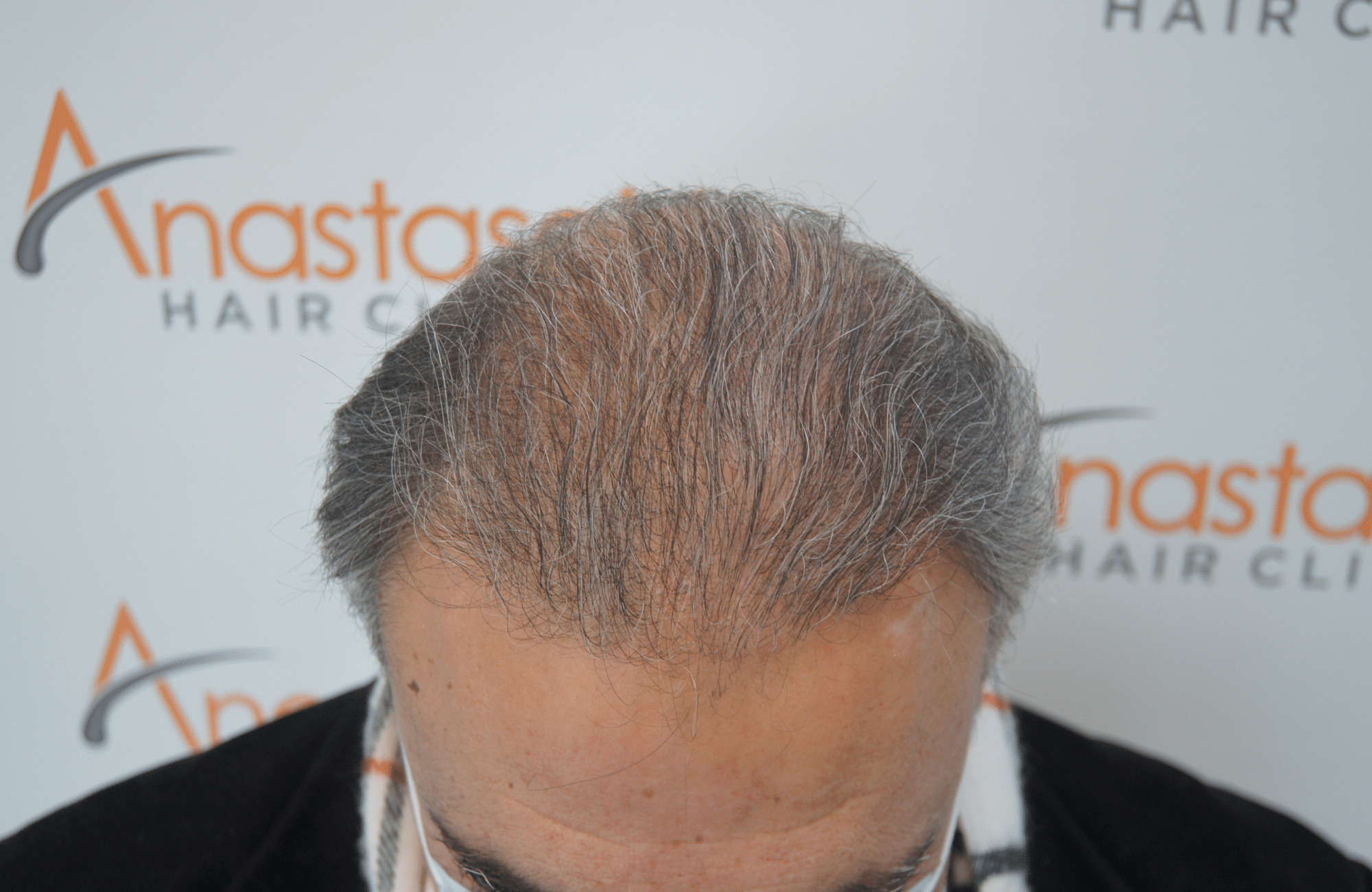 hair transplant patient result with 3000 fus before - frontal