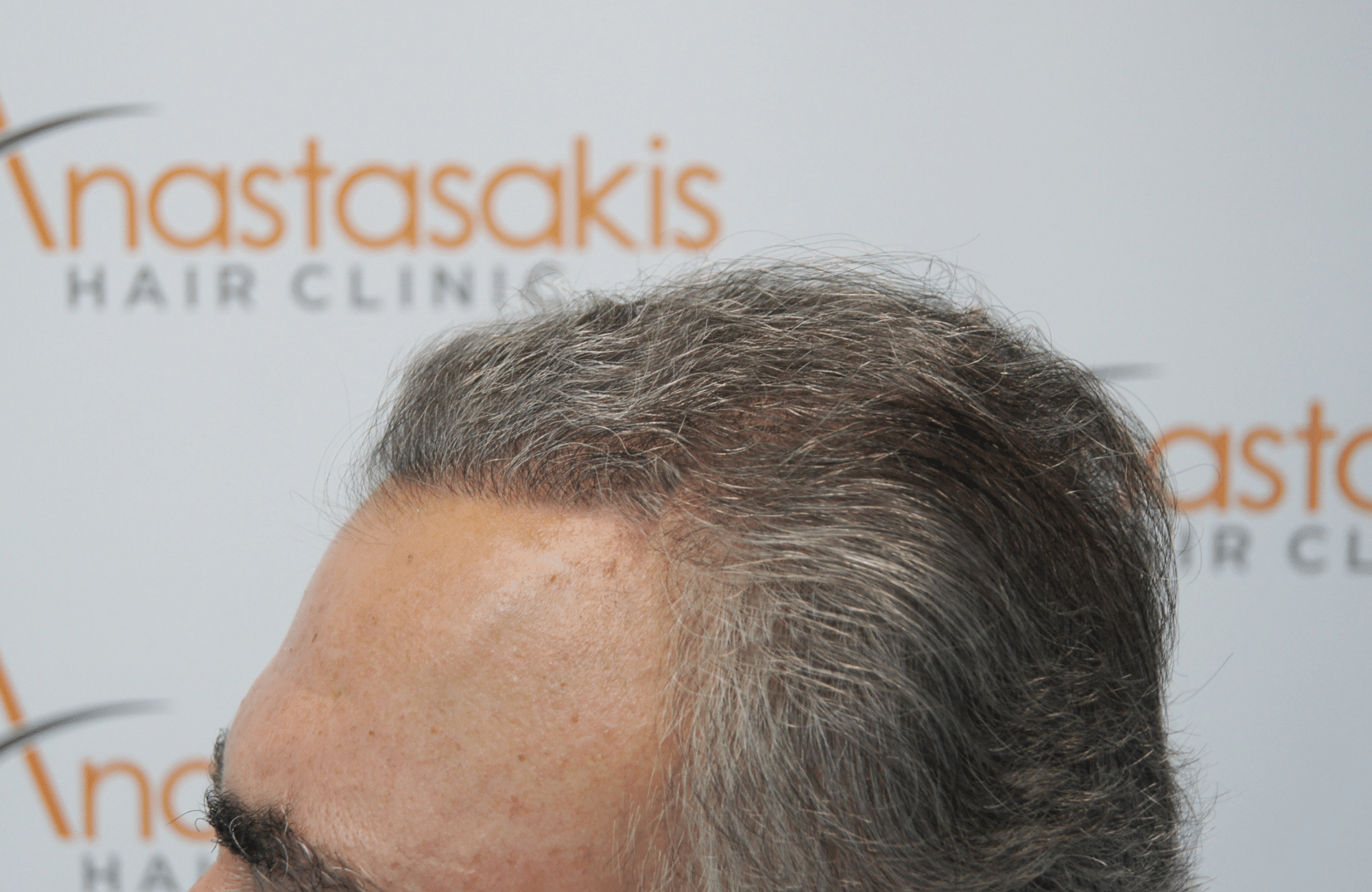 hair transplant patient result with 3000 fus after - side2