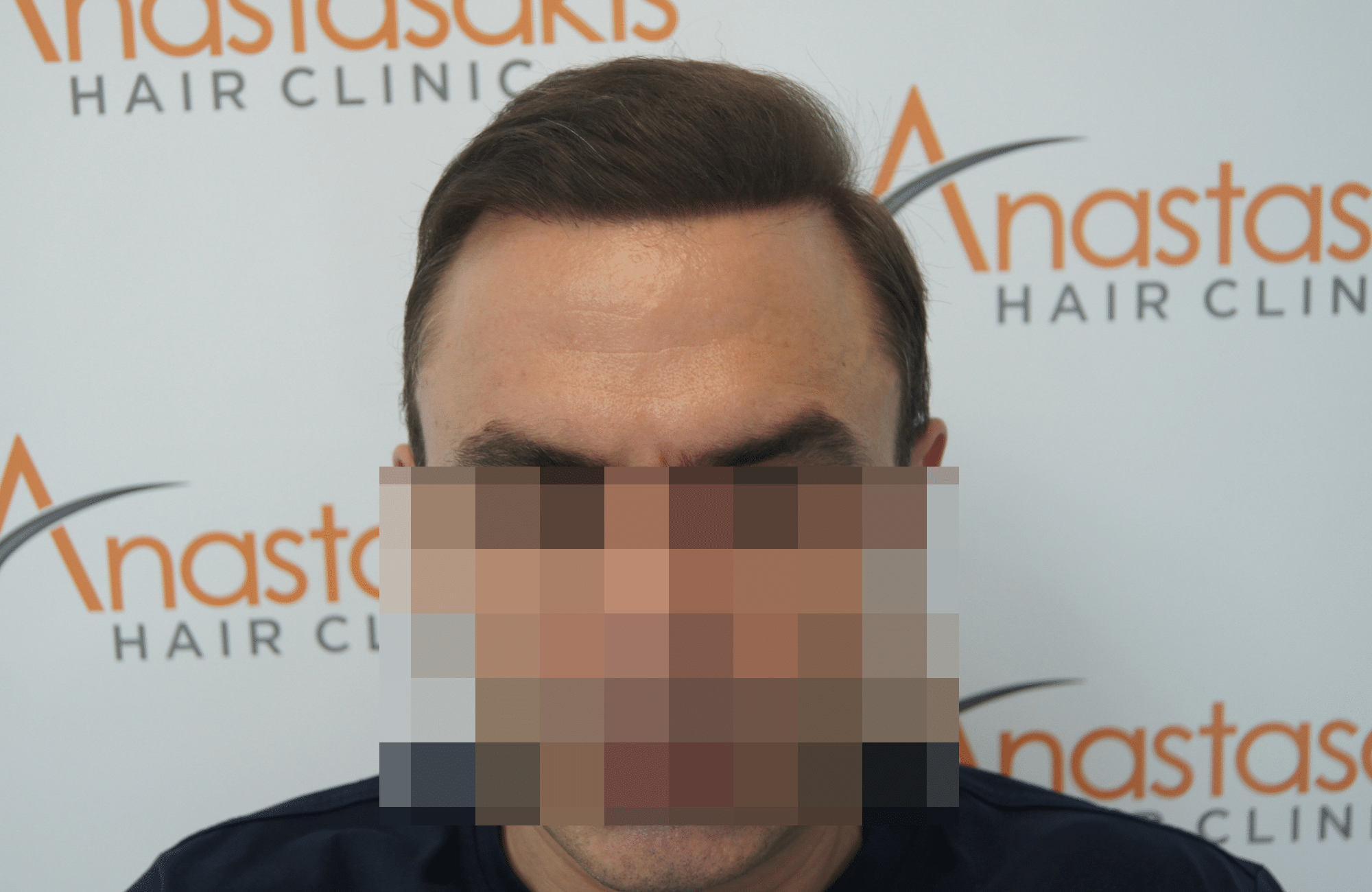 hair transplant patient result with 3000 fus after - fullface