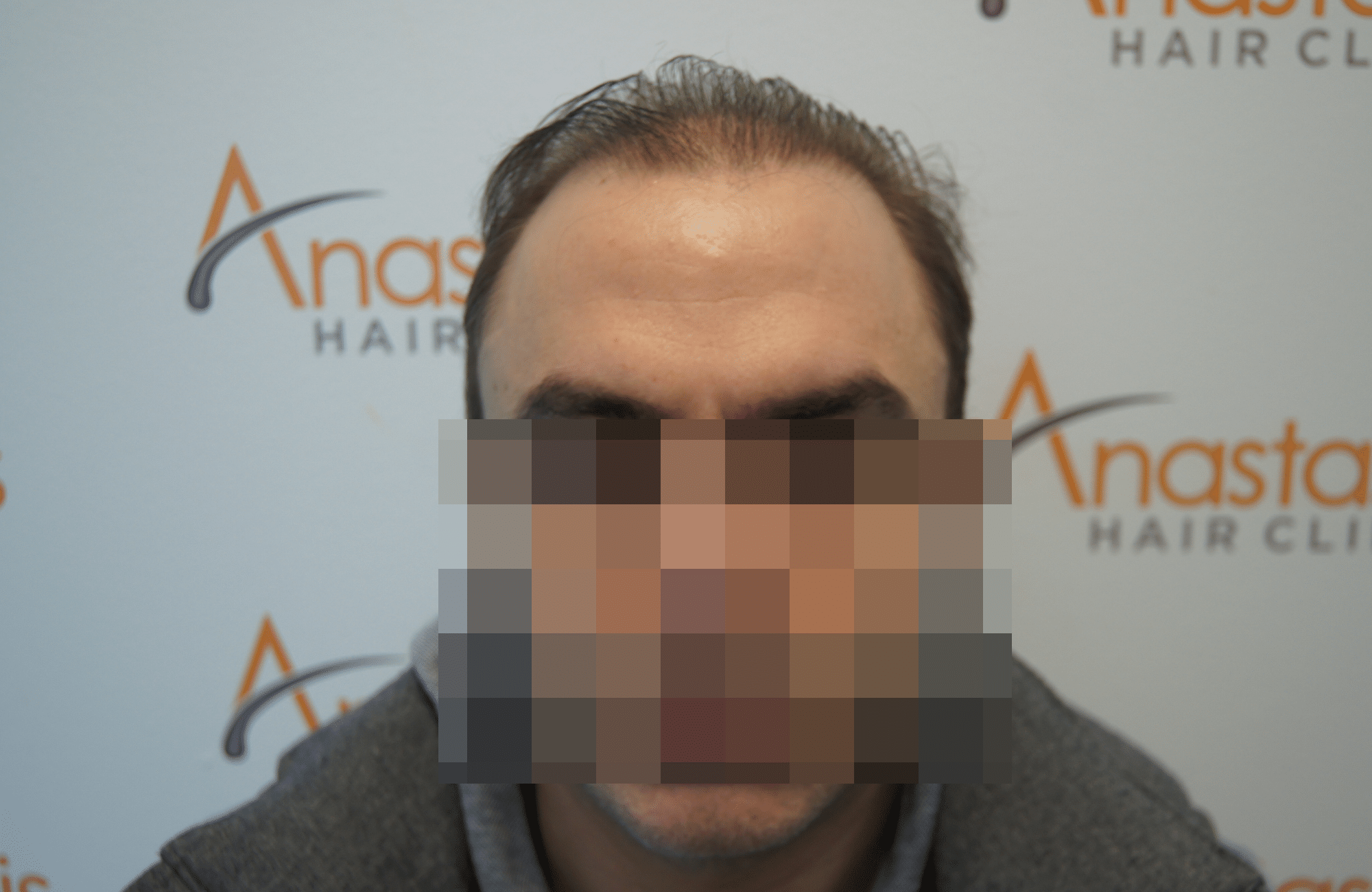 hair transplant patient result with 3000 fus before - fullface
