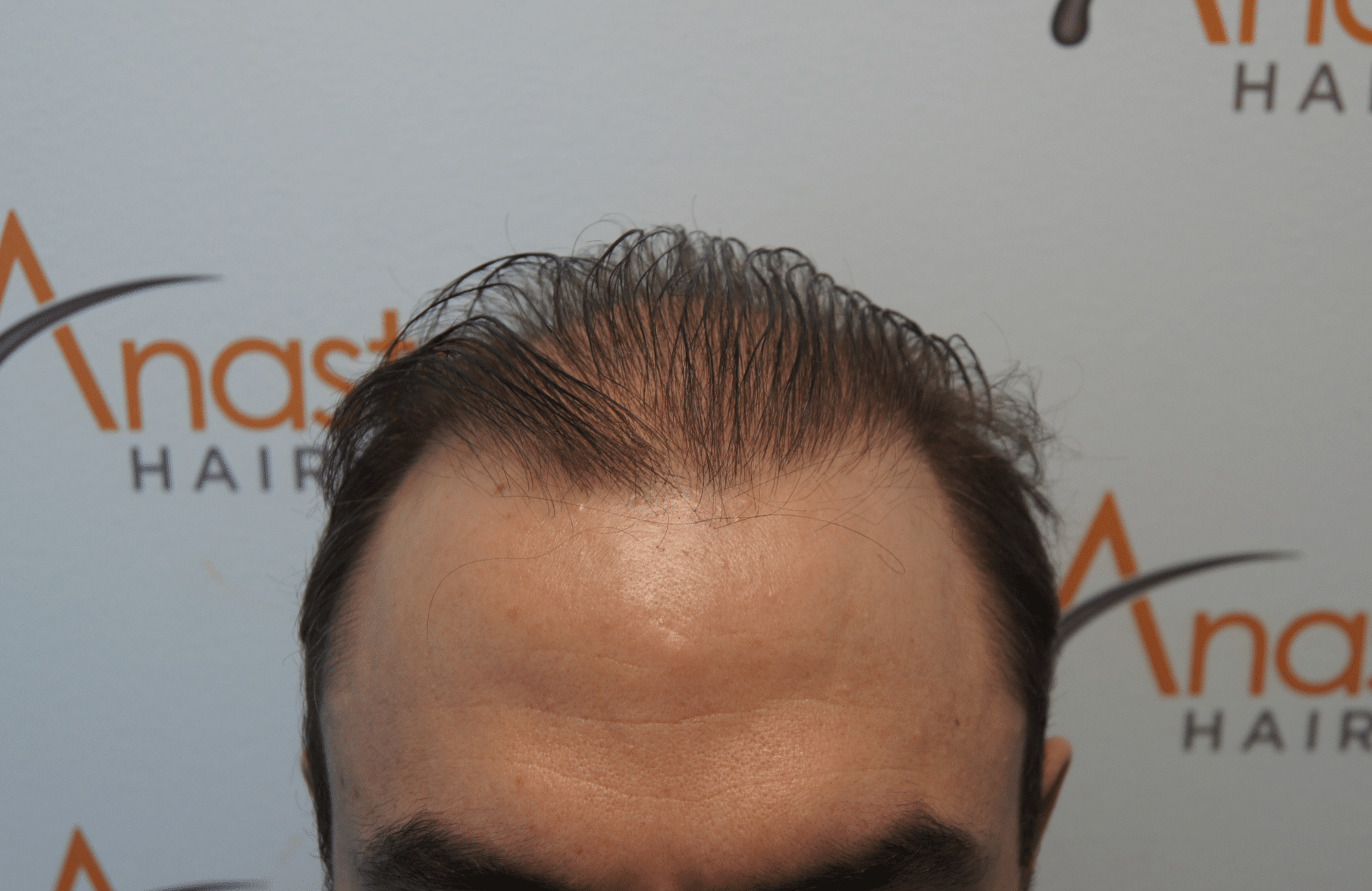 hair transplant patient result with 3000 fus before - hairline
