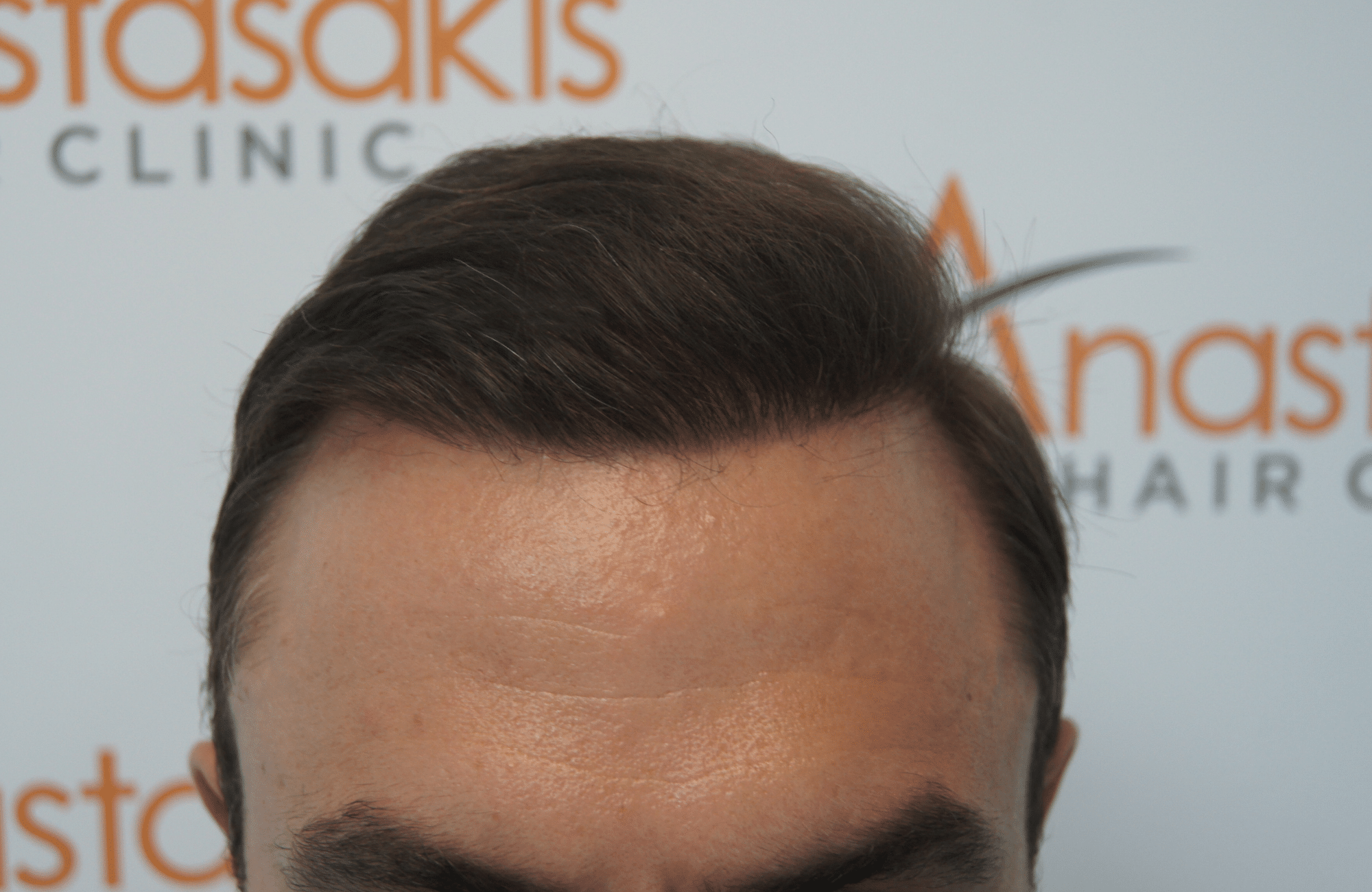 hair transplant patient result with 3000 fus after - hairline