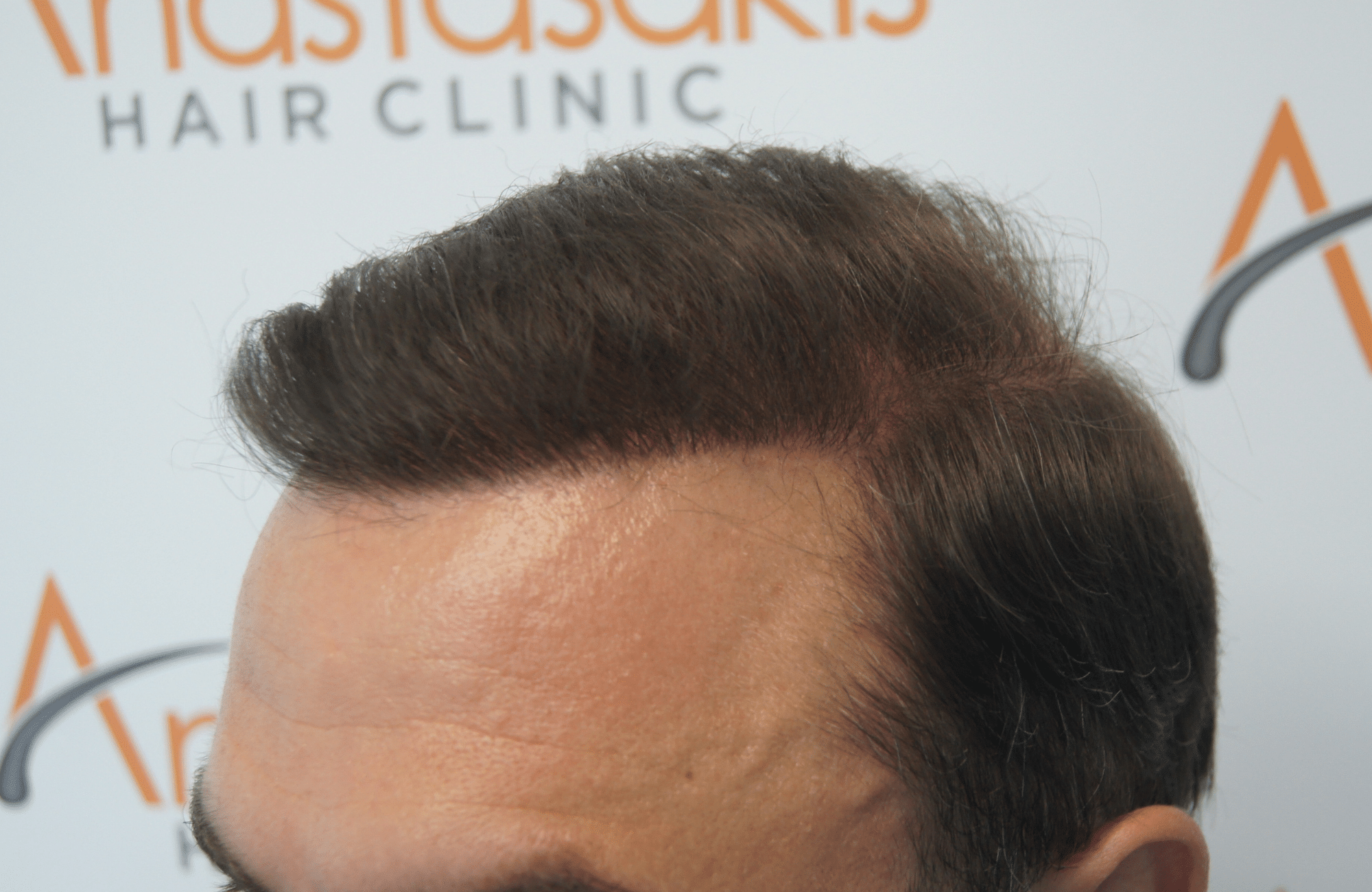 hair transplant patient result with 3000 fus after - side2