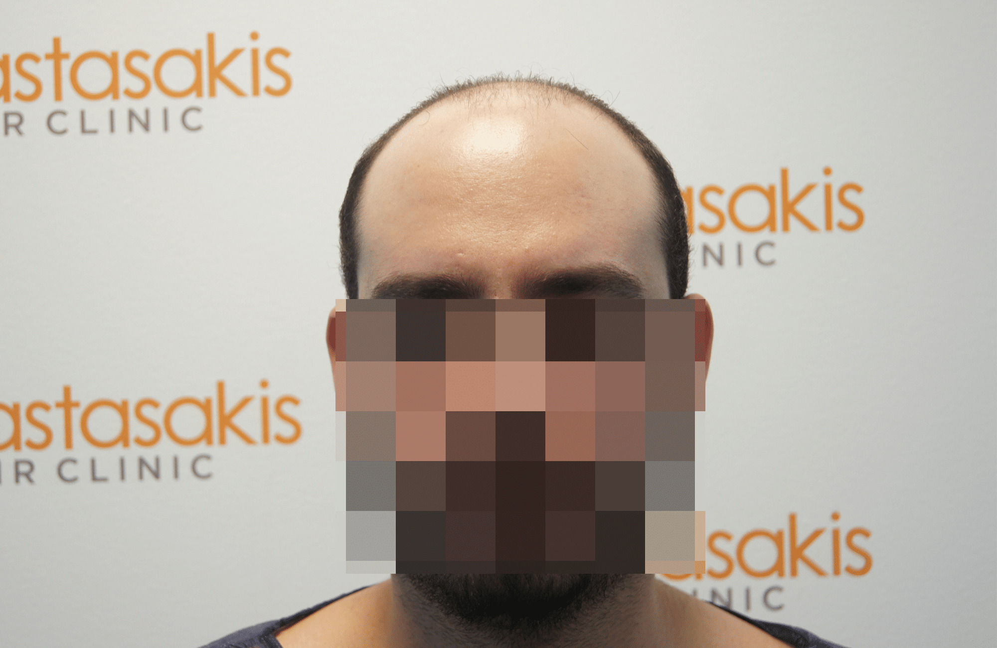 hair transplant result - session with 3200 fus before - hairline