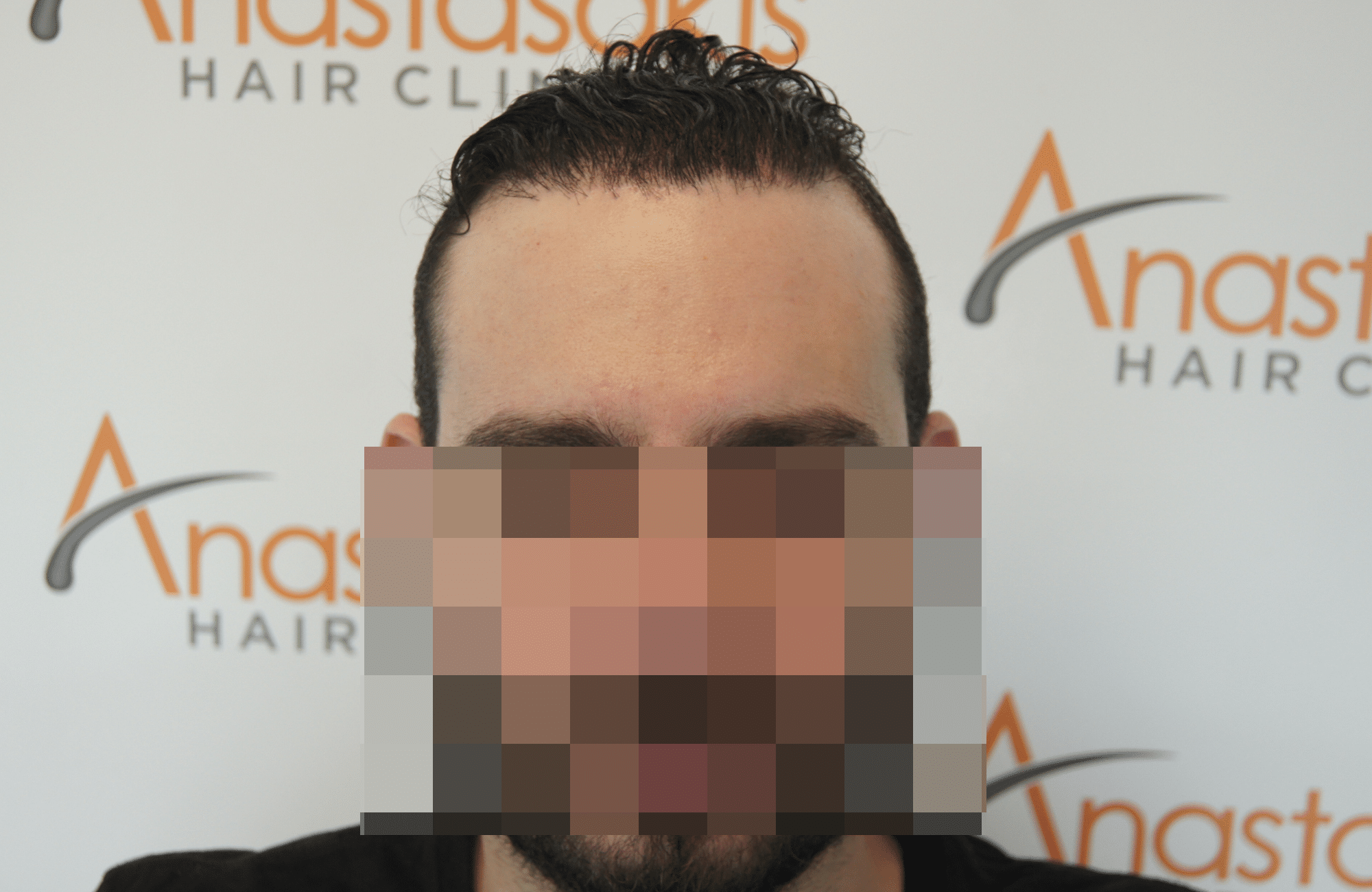 hair transplant result - session with 3200 fus after - hairline wet hair