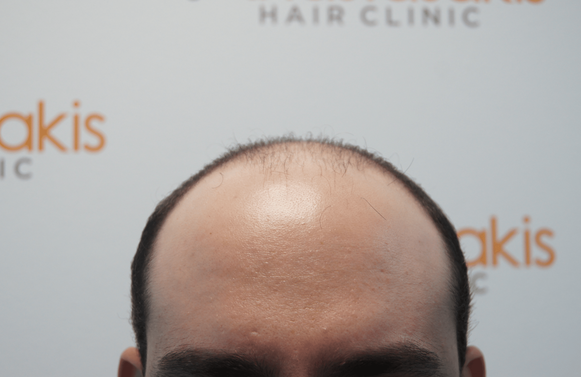 hair transplant result - session with 3200 fus before - hairline