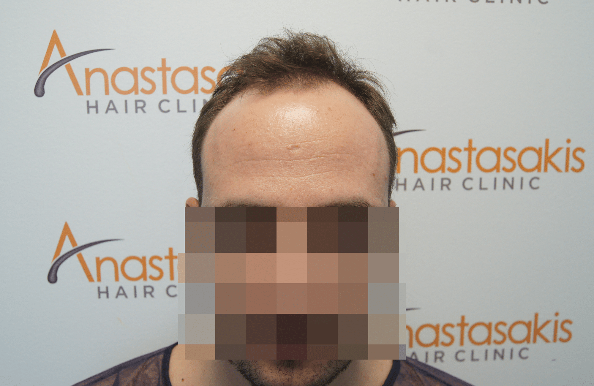 hair transplant result with 3500 fus before - fullface